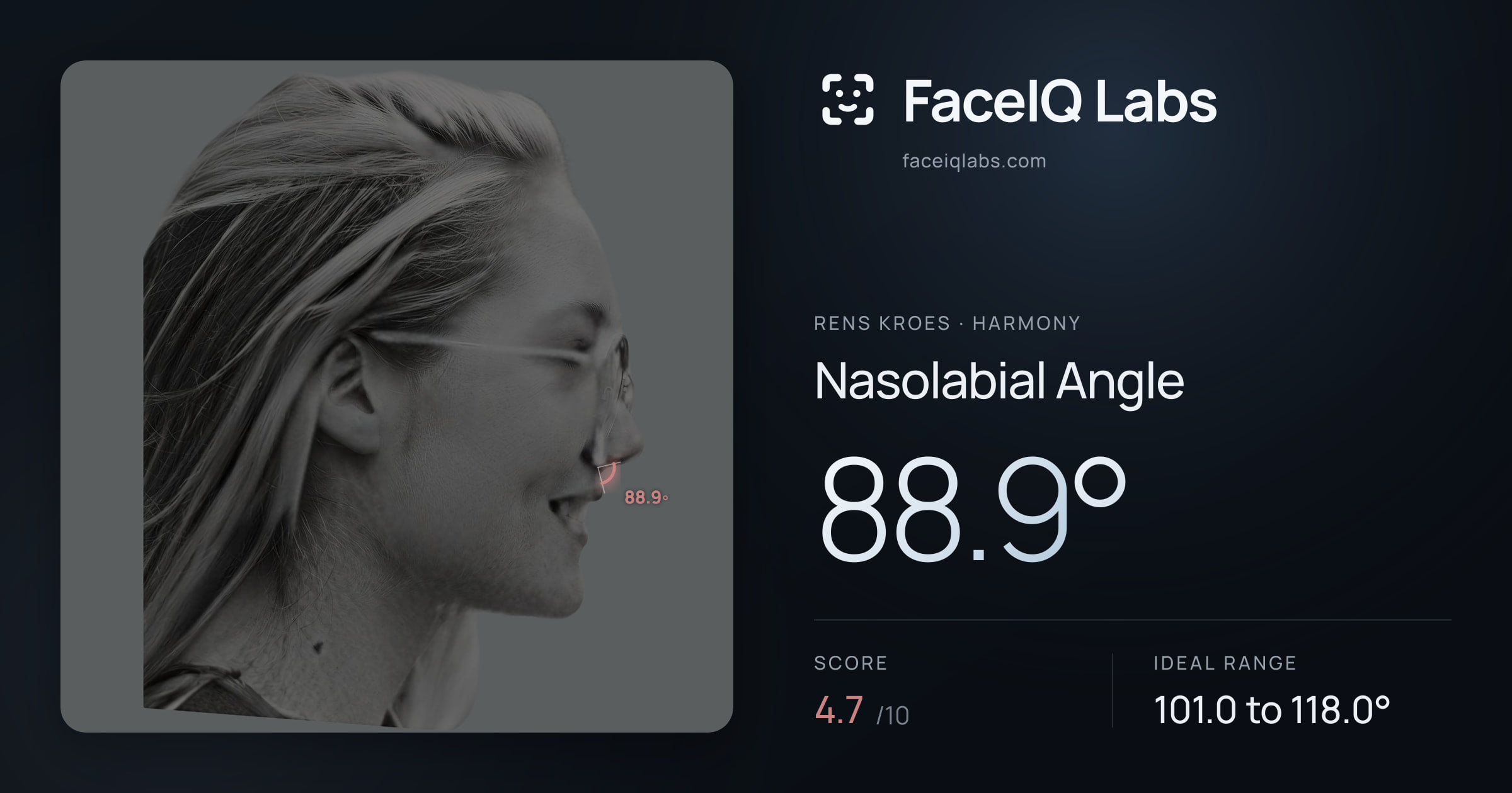 Rens Kroes Nasolabial Angle: 88.9°, drawn on the photo