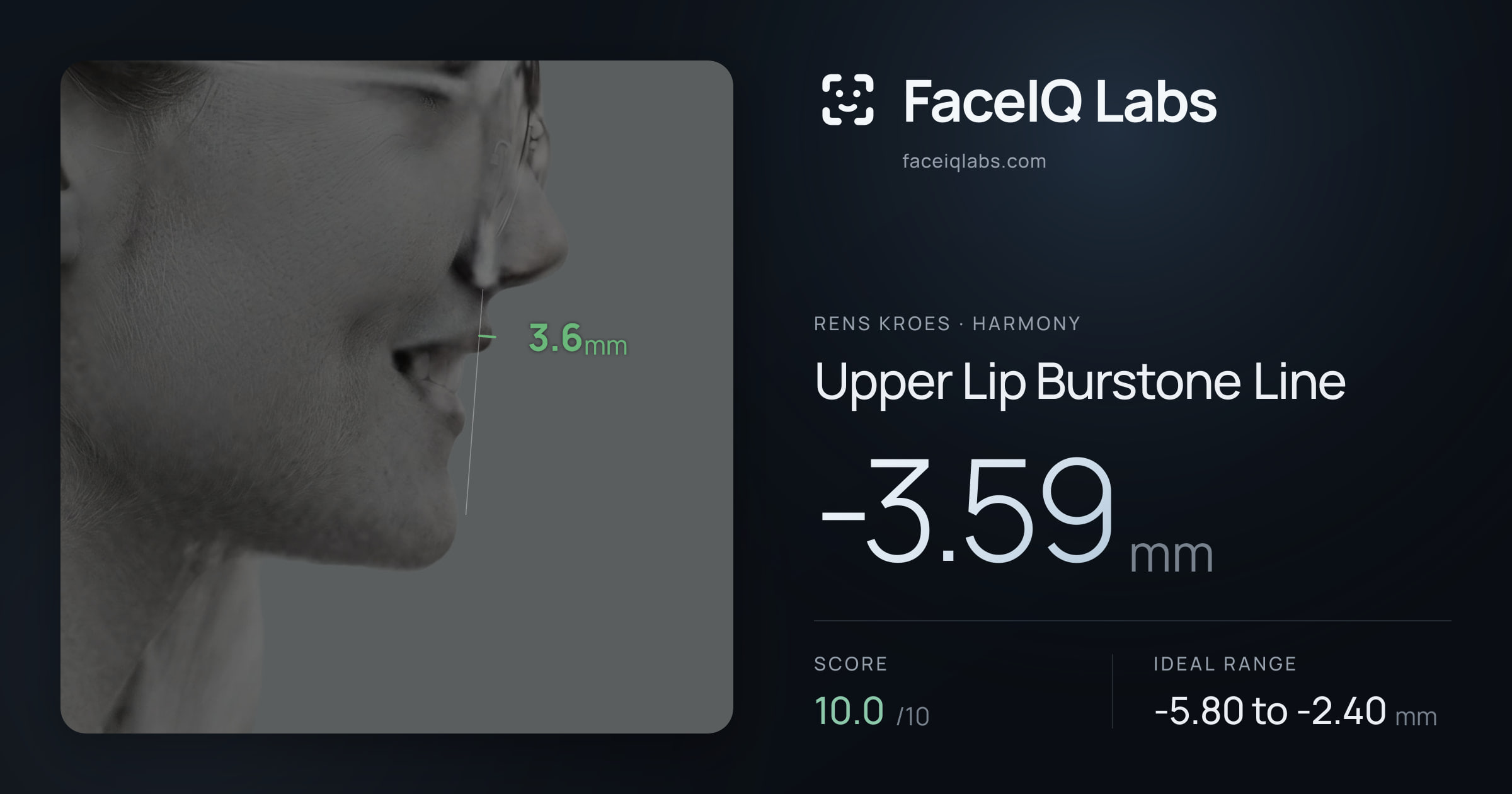 Rens Kroes Upper Lip Burstone Line: -3.59mm, drawn on the photo