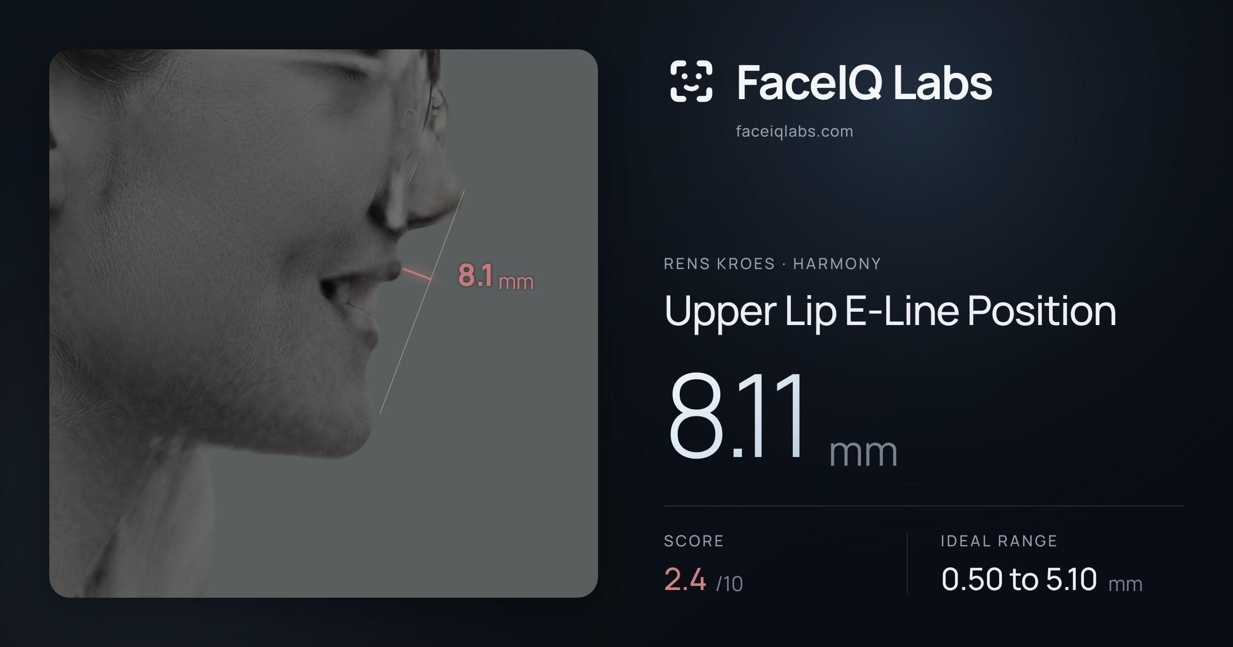 Rens Kroes Upper Lip E-Line Position: 8.11mm, drawn on the photo