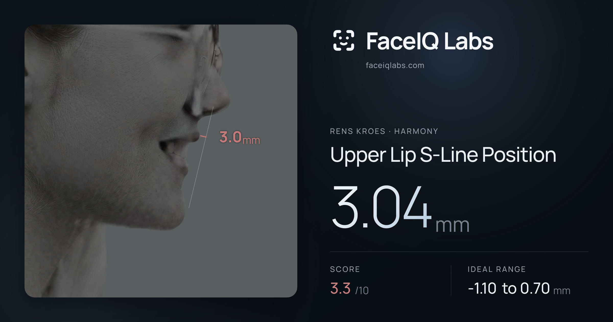 Rens Kroes Upper Lip S-Line Position: 3.04mm, drawn on the photo