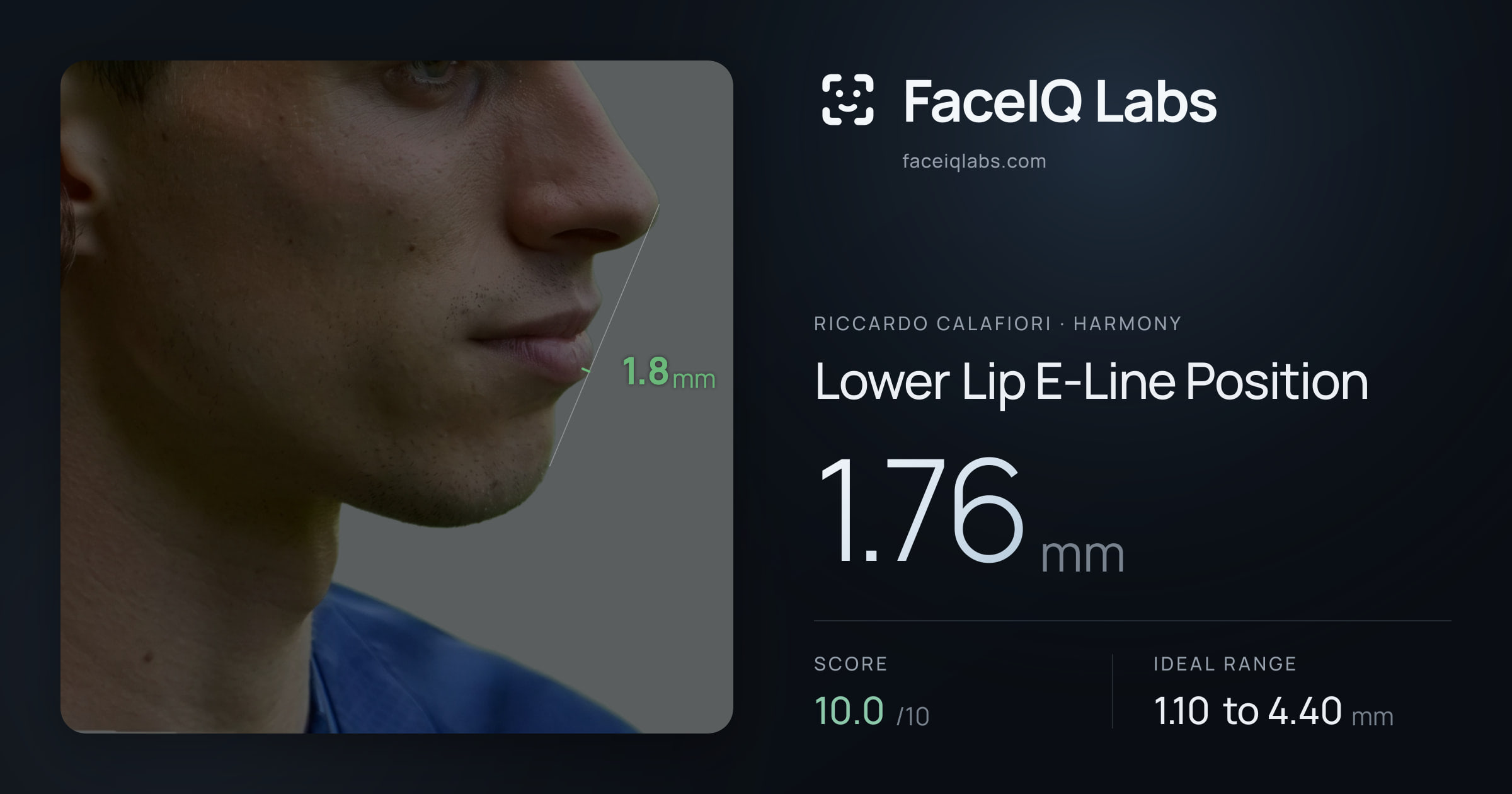 Riccardo Calafiori Lower Lip E-Line Position: 1.76mm, drawn on the photo