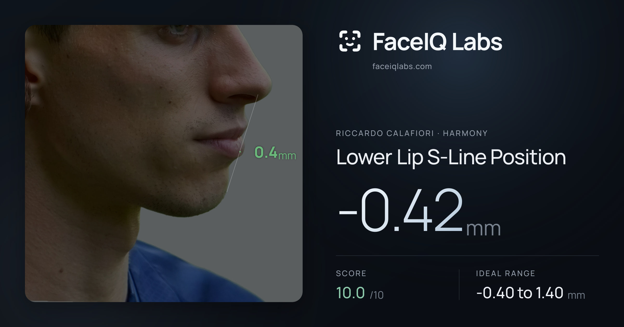 Riccardo Calafiori Lower Lip S-Line Position: -0.42mm, drawn on the photo