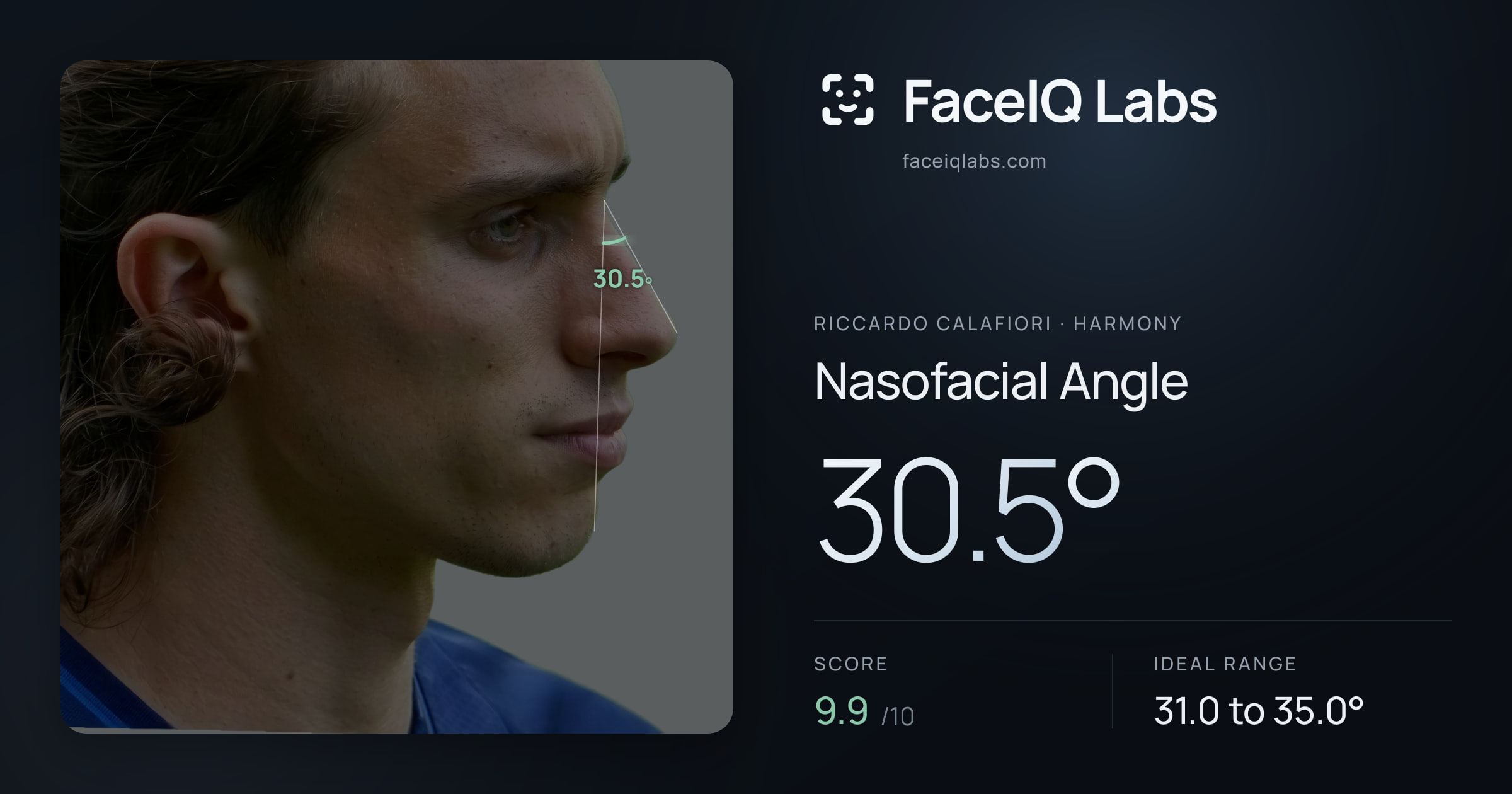 Riccardo Calafiori Nasofacial Angle: 30.5°, drawn on the photo