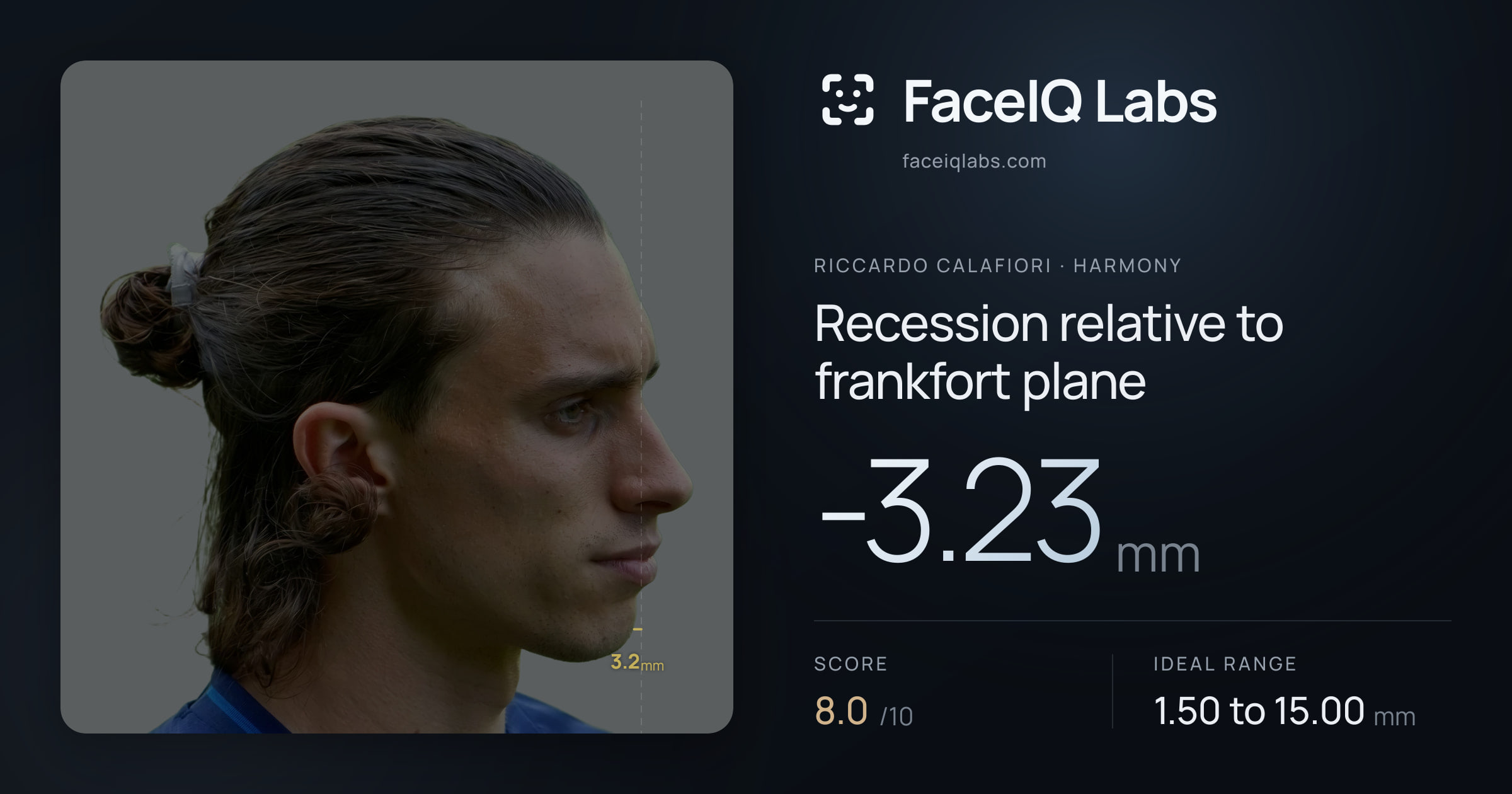 Riccardo Calafiori Recession relative to frankfort plane: -3.23mm, drawn on the photo