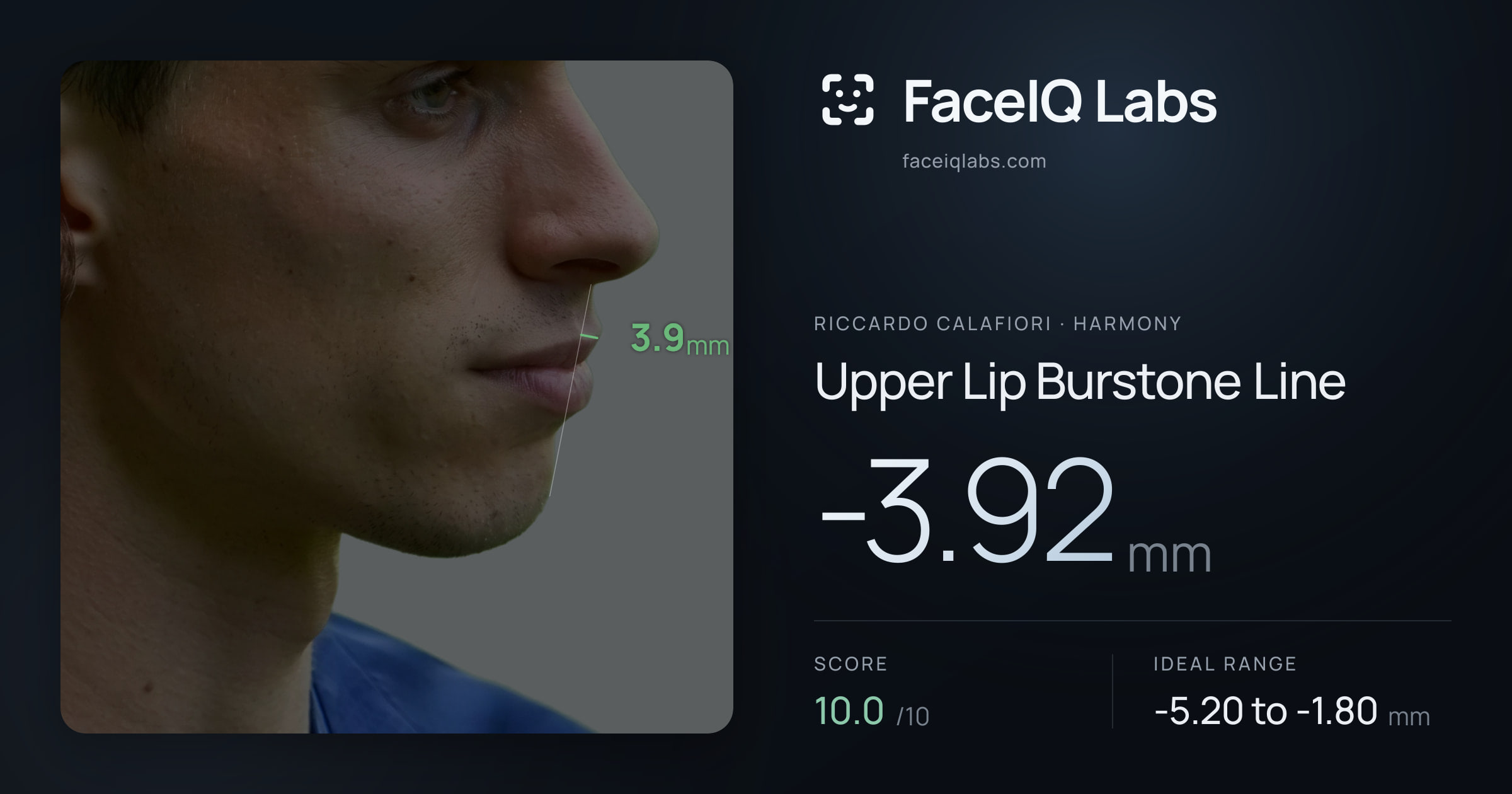 Riccardo Calafiori Upper Lip Burstone Line: -3.92mm, drawn on the photo