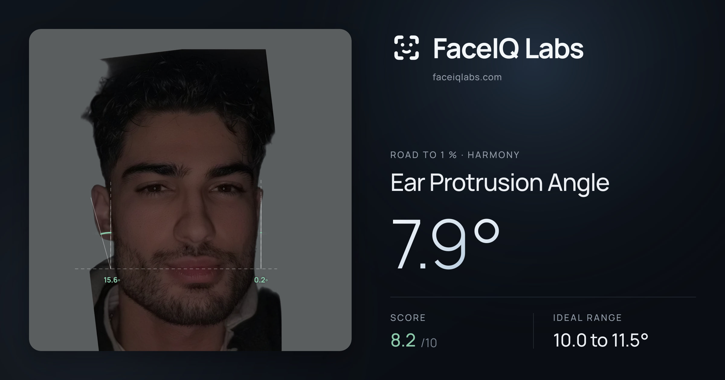 Road To 1 % Ear Protrusion Angle: 7.9°, drawn on the photo