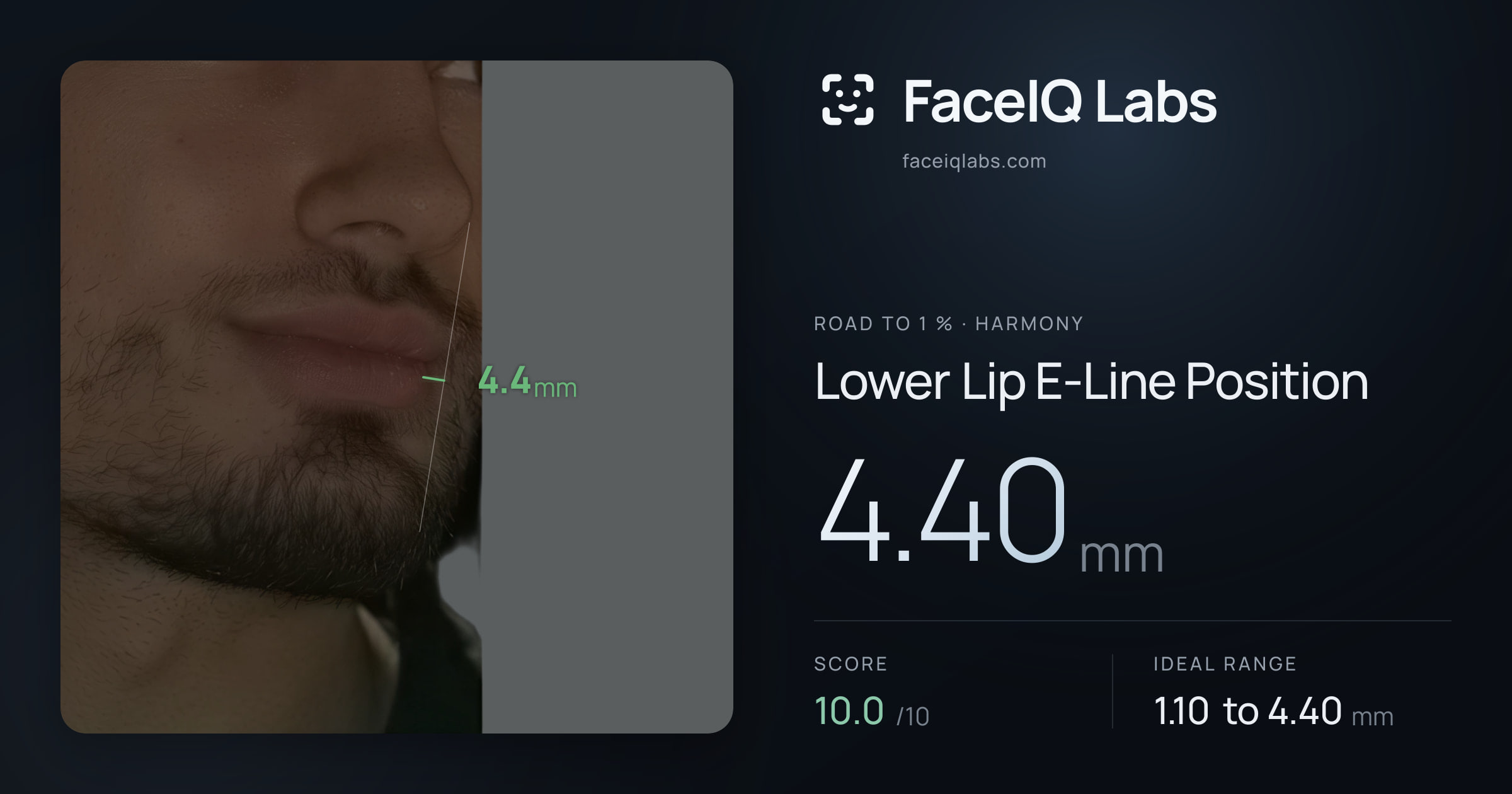 Road To 1 % Lower Lip E-Line Position: 4.40mm, drawn on the photo