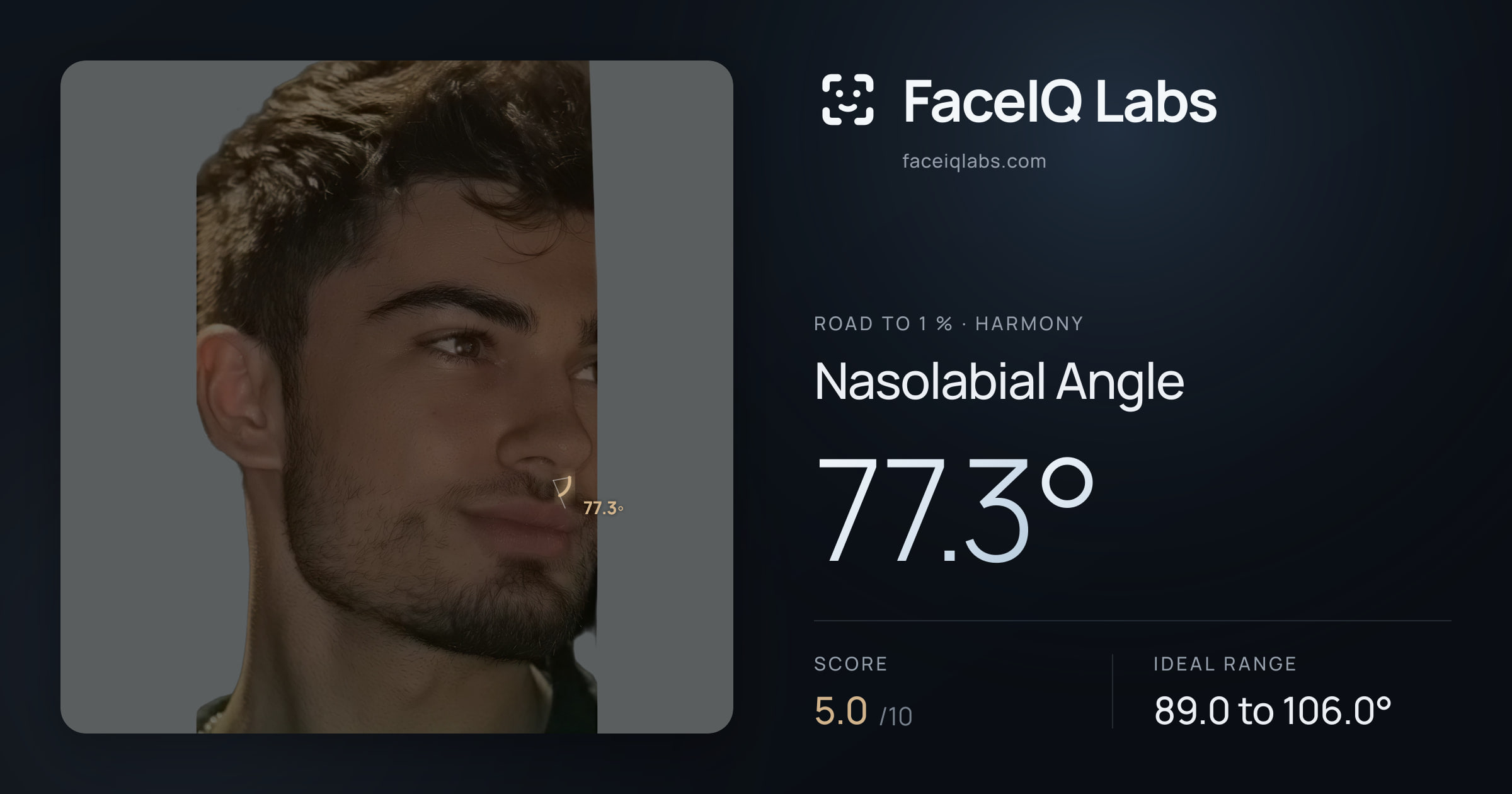 Road To 1 % Nasolabial Angle: 77.3°, drawn on the photo