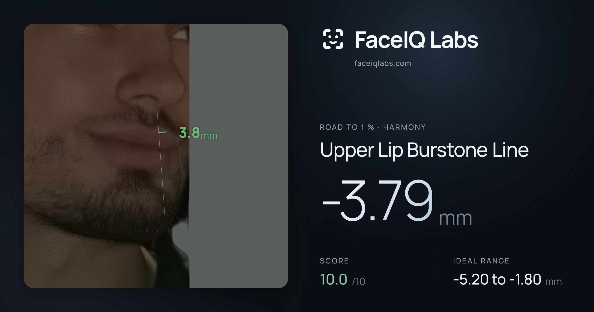 Road To 1 % Upper Lip Burstone Line: -3.79mm, drawn on the photo