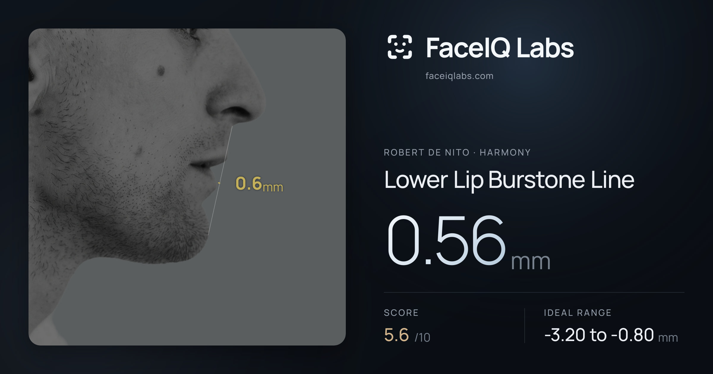 Robert De Nito Lower Lip Burstone Line: 0.56mm, drawn on the photo