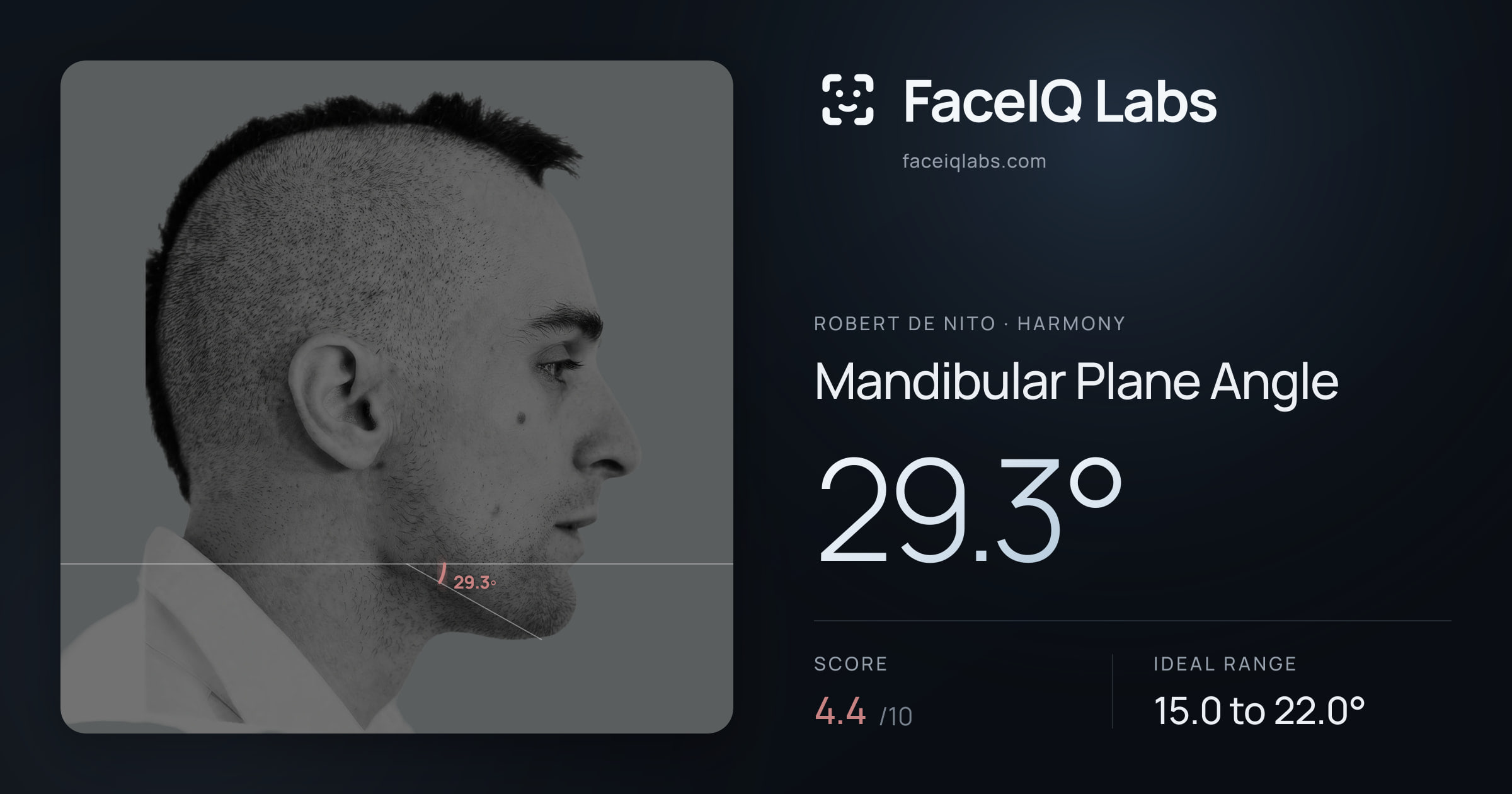 Robert De Nito Mandibular Plane Angle: 29.3°, drawn on the photo