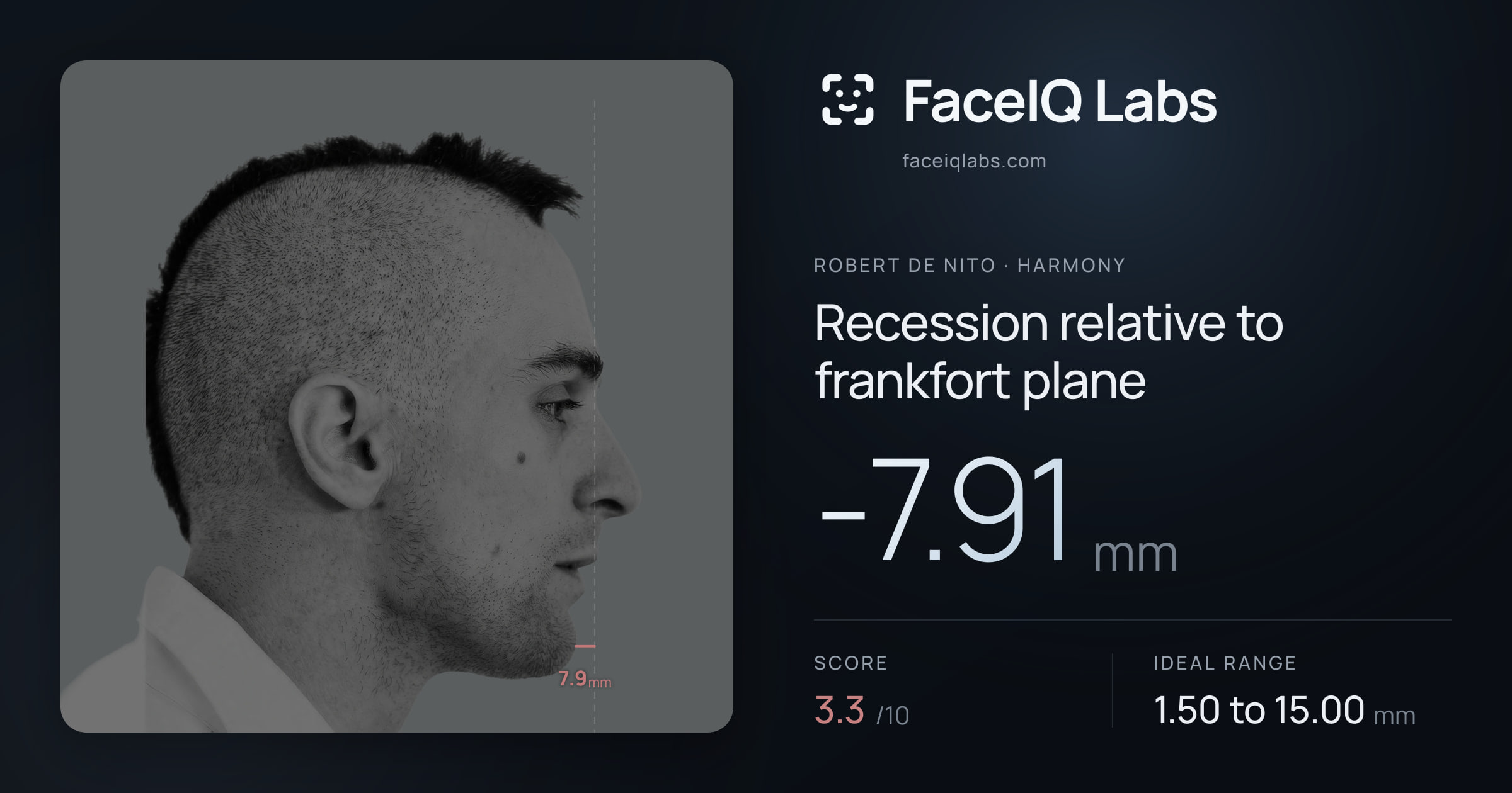Robert De Nito Recession relative to frankfort plane: -7.91mm, drawn on the photo