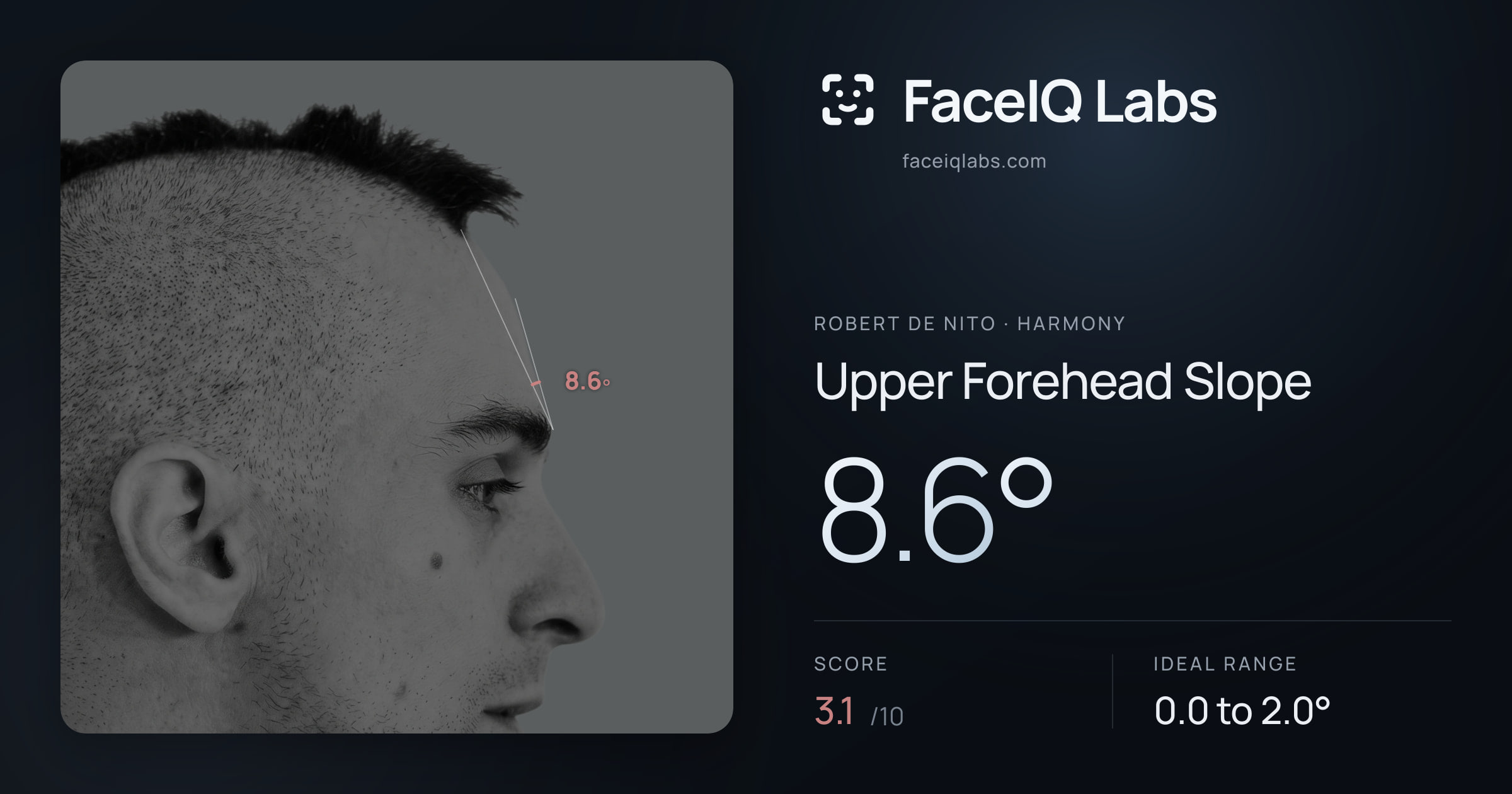 Robert De Nito Upper Forehead Slope: 8.6°, drawn on the photo