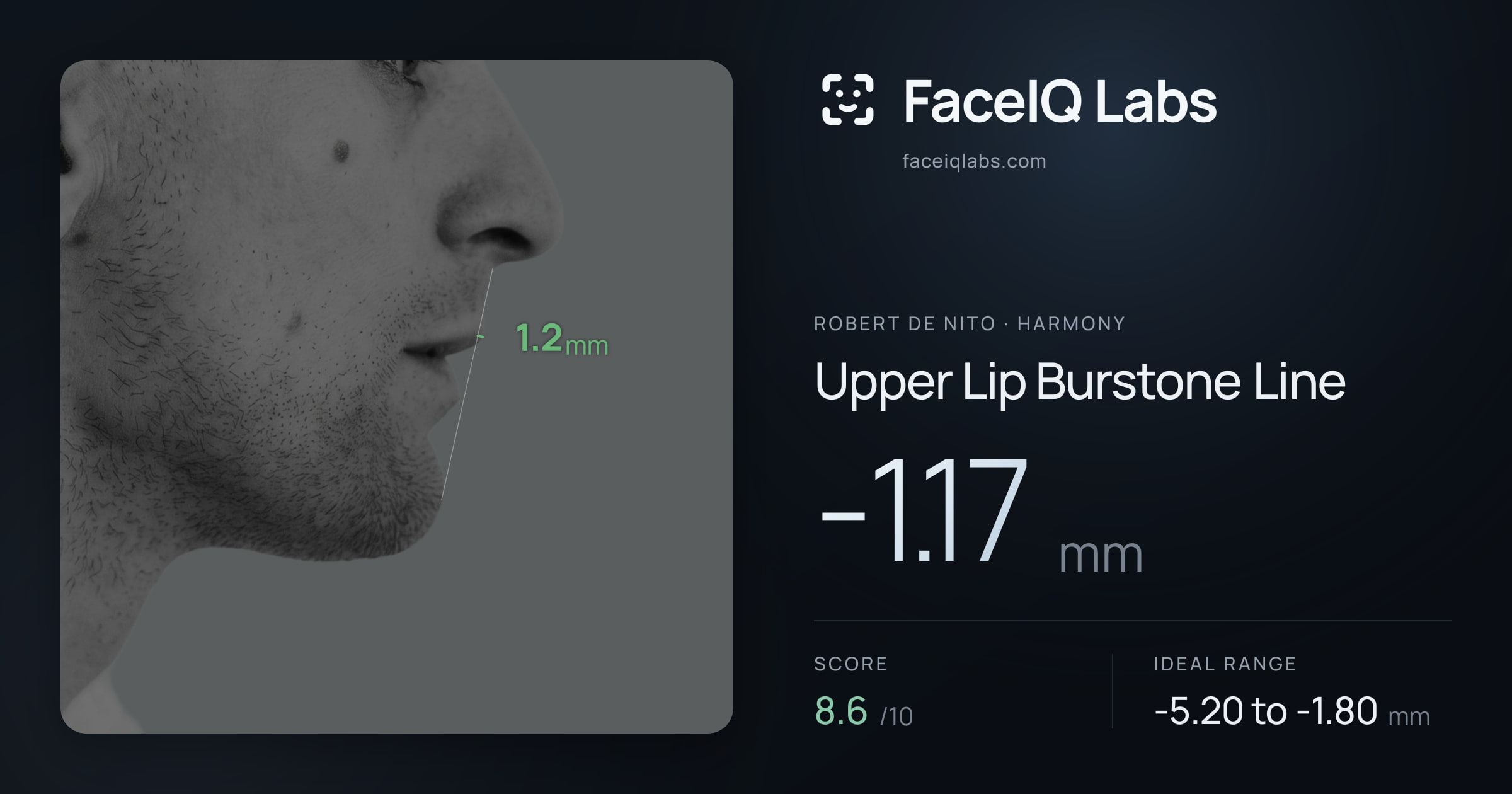 Robert De Nito Upper Lip Burstone Line: -1.17mm, drawn on the photo