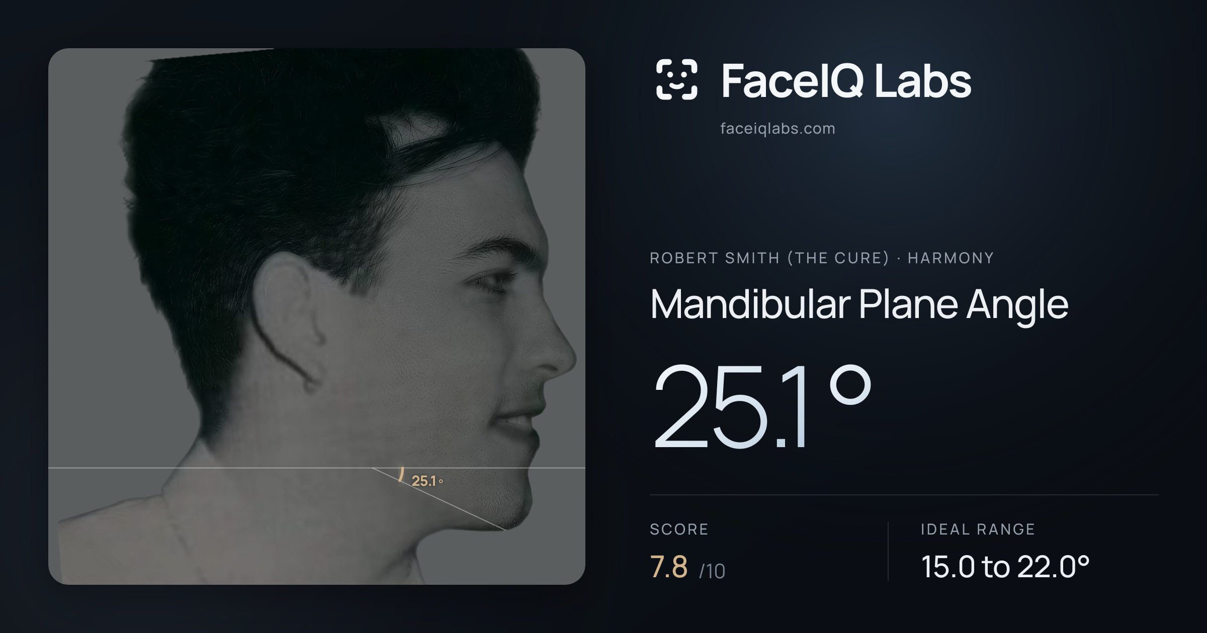 Robert Smith (The cure) Mandibular Plane Angle: 25.1°, drawn on the photo