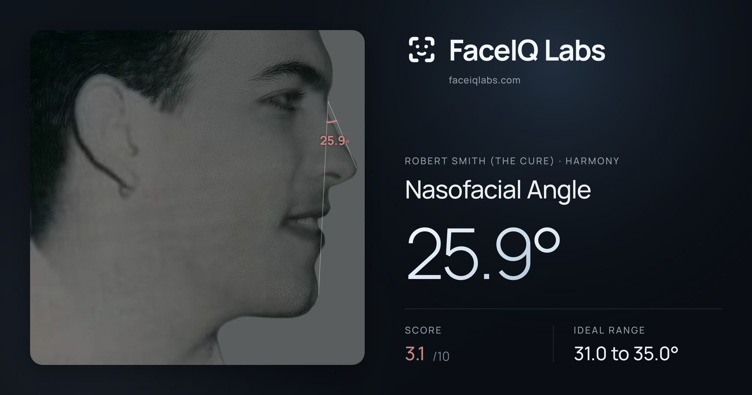 Robert Smith (The cure) Nasofacial Angle: 25.9°, drawn on the photo