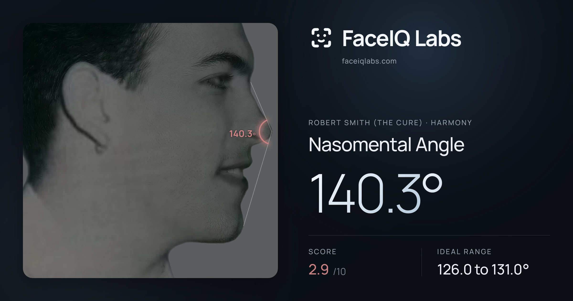 Robert Smith (The cure) Nasomental Angle: 140.3°, drawn on the photo