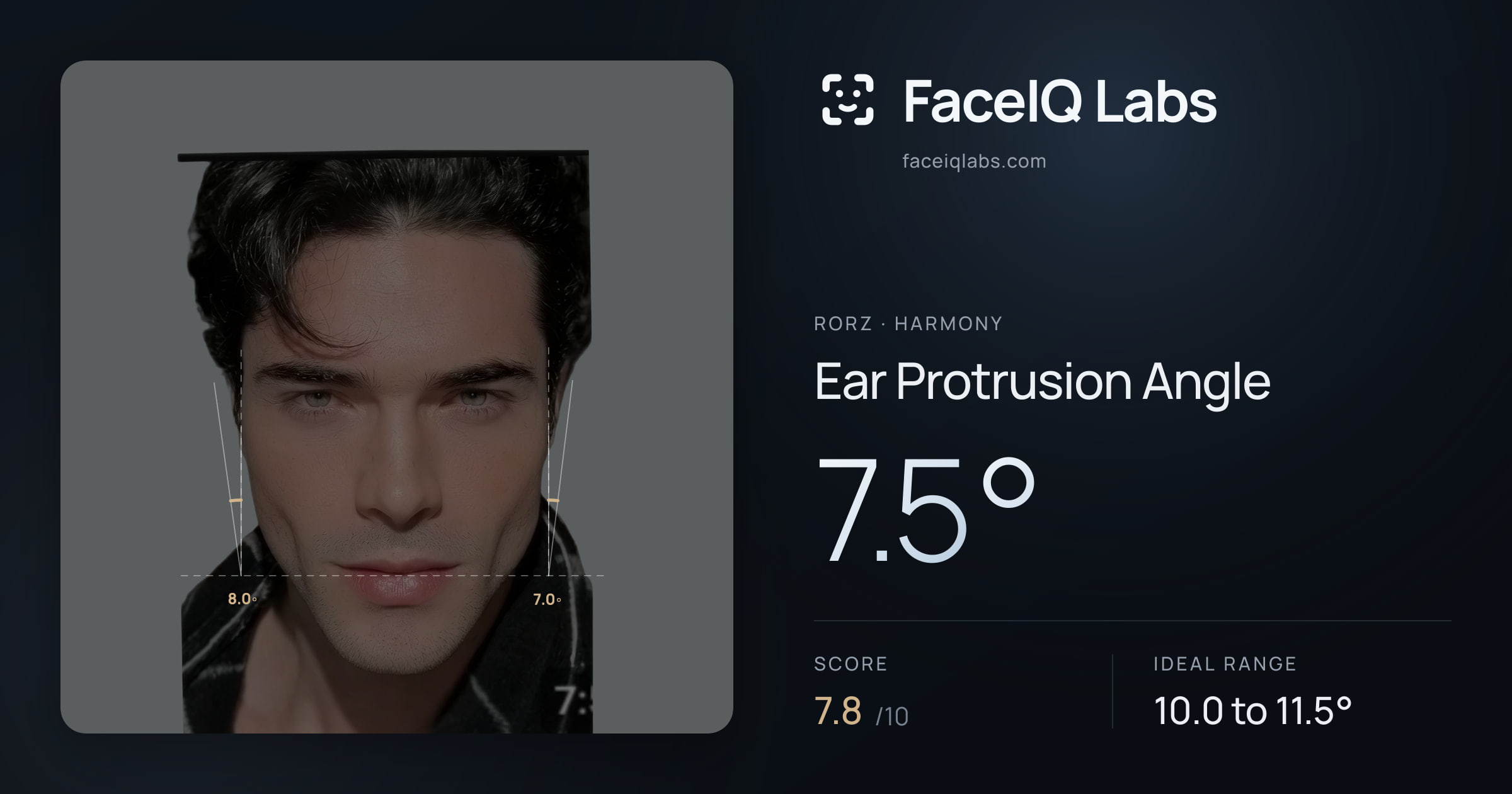 Rorz Ear Protrusion Angle: 7.5°, drawn on the photo