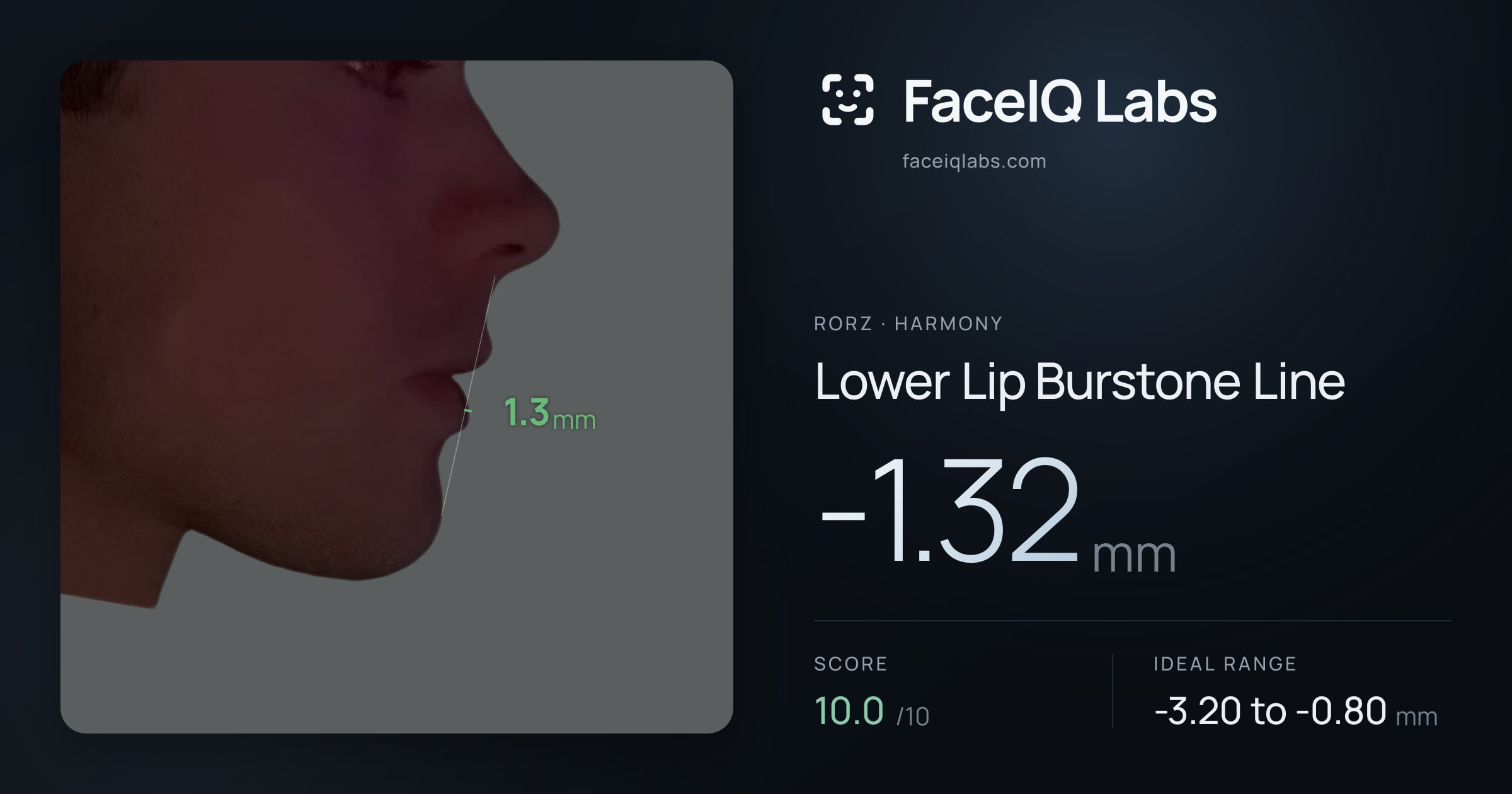 Rorz Lower Lip Burstone Line: -1.32mm, drawn on the photo