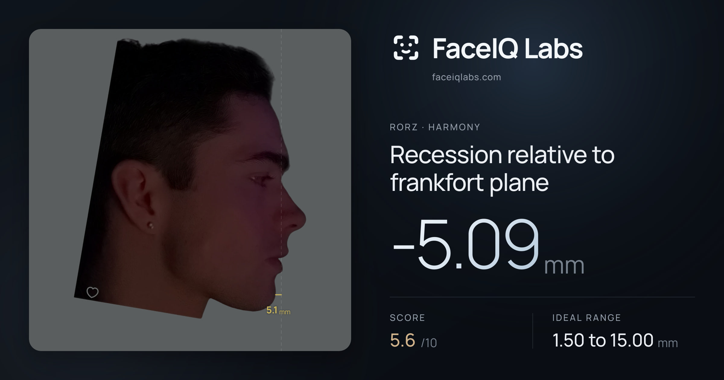 Rorz Recession relative to frankfort plane: -5.09mm, drawn on the photo