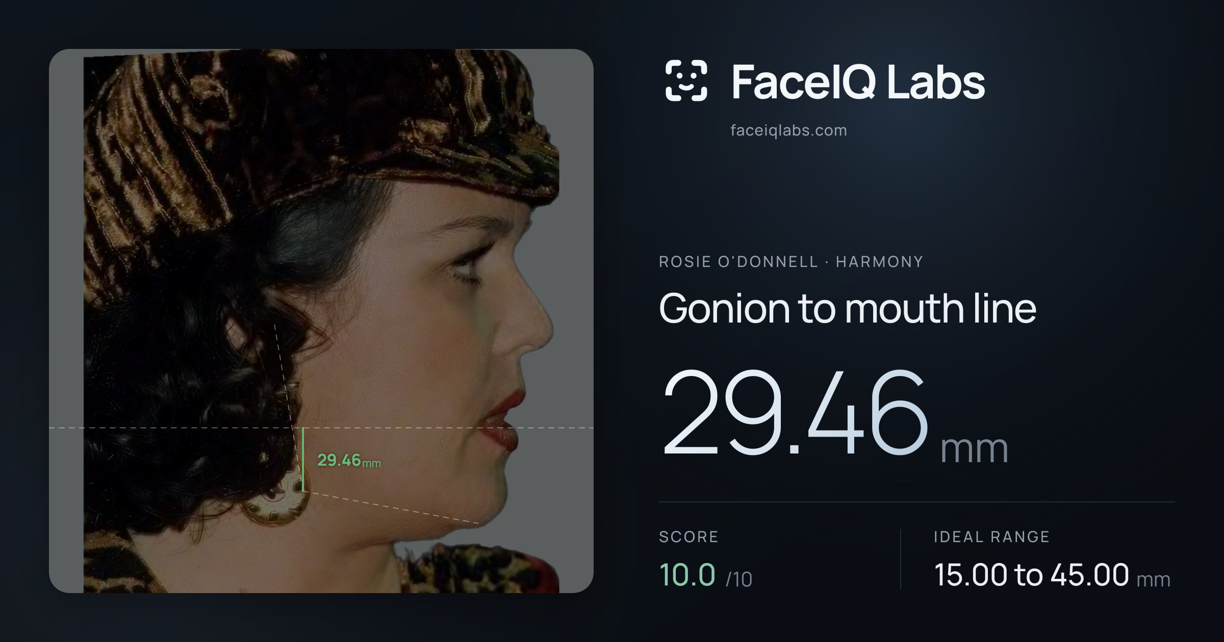 Rosie O'Donnell Gonion to mouth line: 29.46mm, drawn on the photo