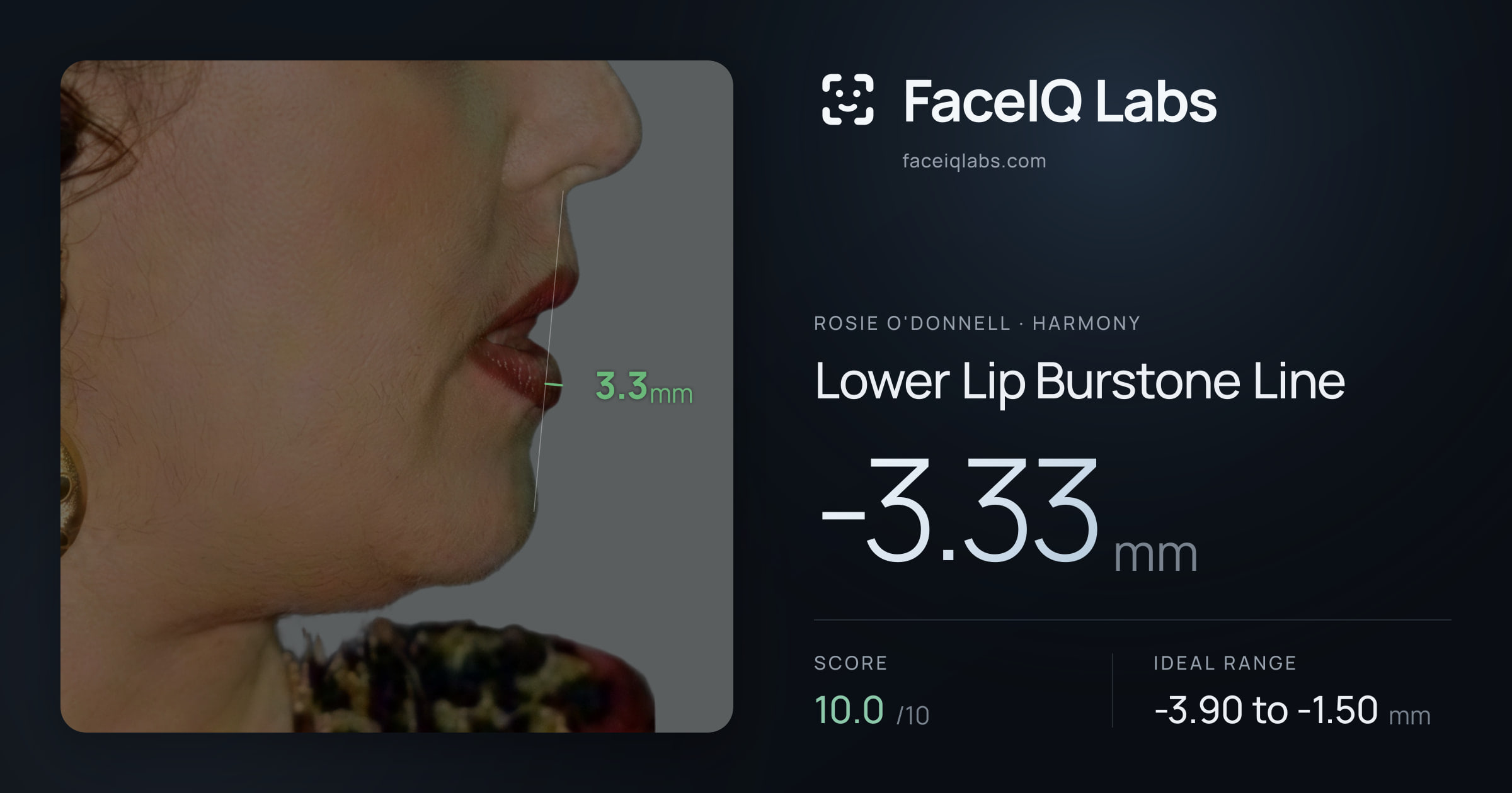 Rosie O'Donnell Lower Lip Burstone Line: -3.33mm, drawn on the photo