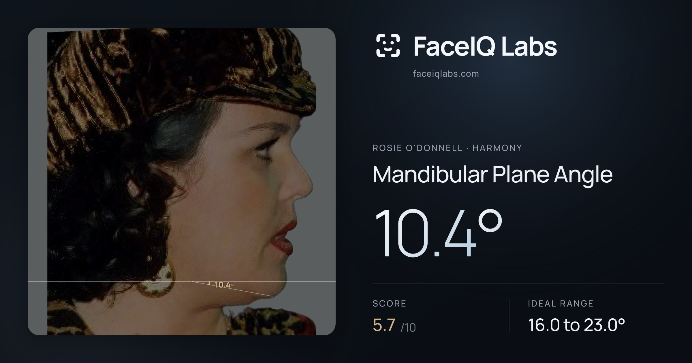 Rosie O'Donnell Mandibular Plane Angle: 10.4°, drawn on the photo