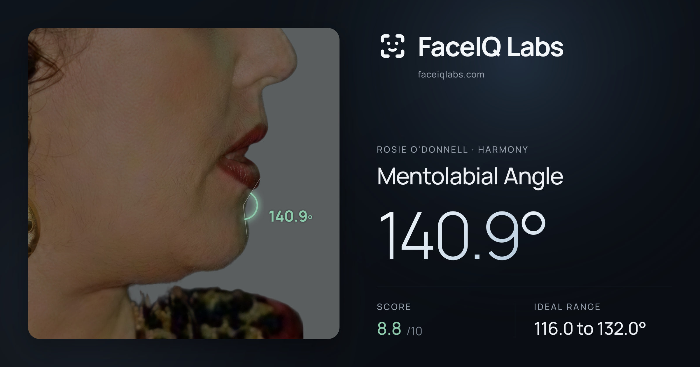 Rosie O'Donnell Mentolabial Angle: 140.9°, drawn on the photo