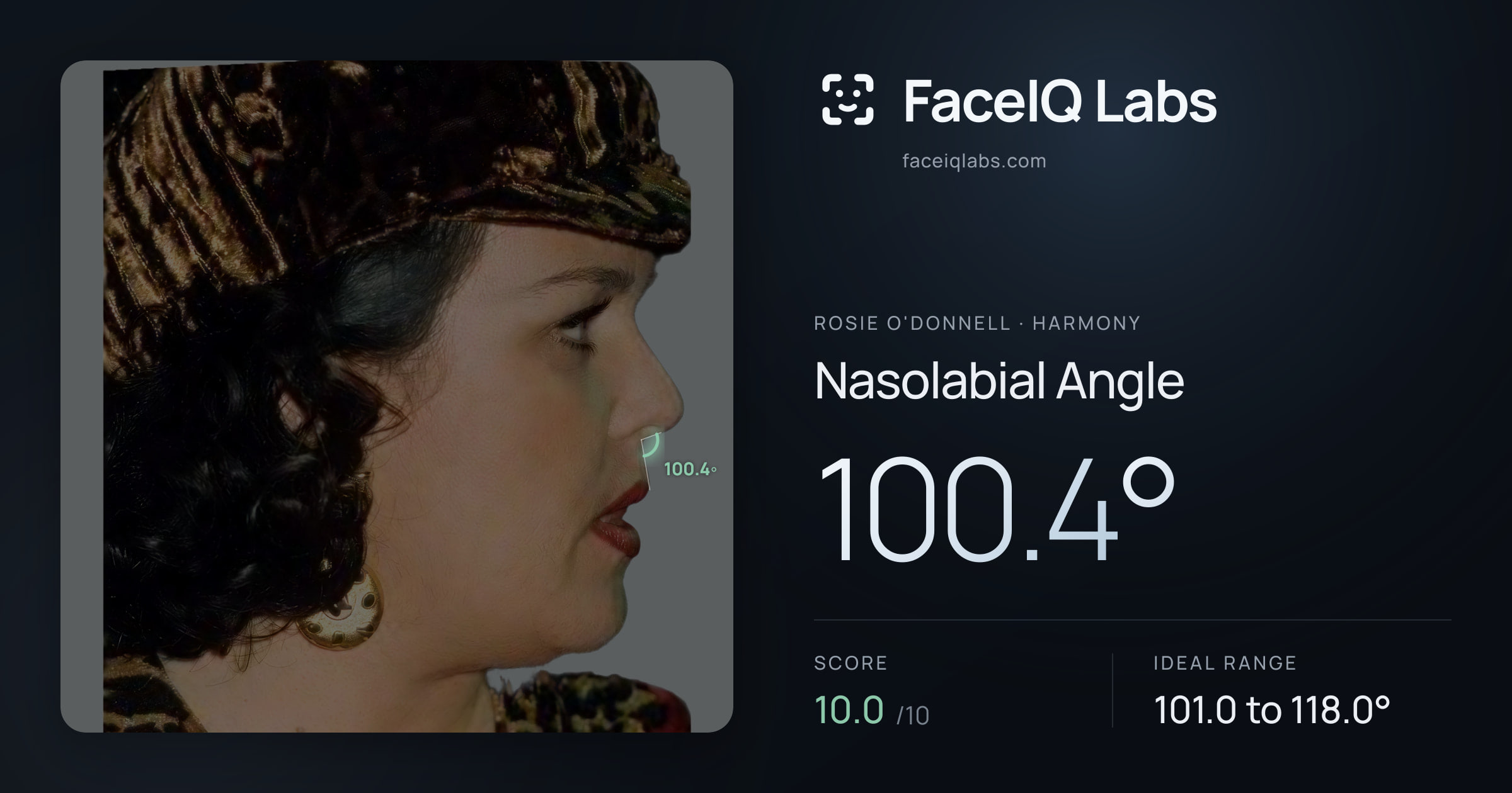Rosie O'Donnell Nasolabial Angle: 100.4°, drawn on the photo