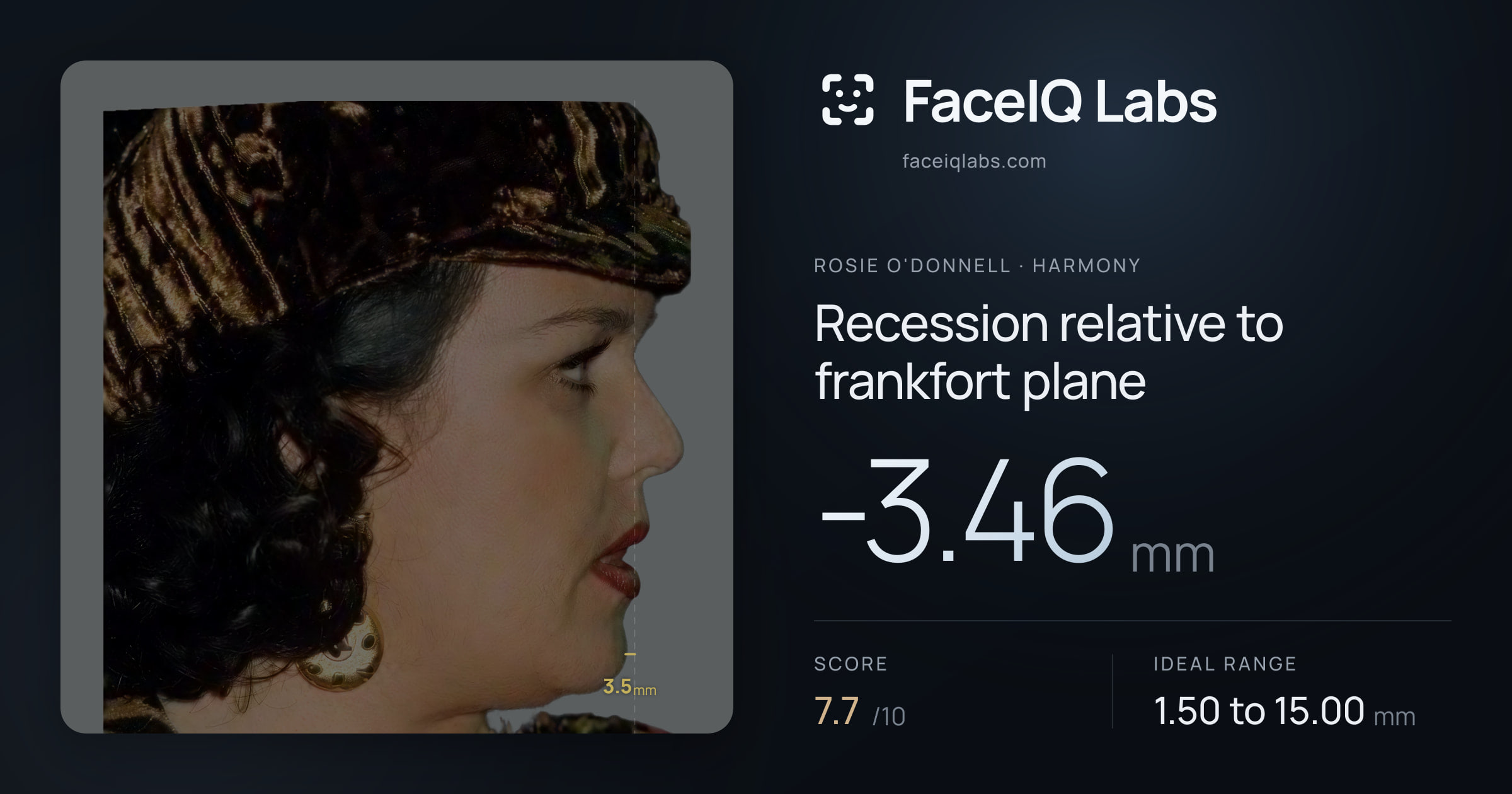Rosie O'Donnell Recession relative to frankfort plane: -3.46mm, drawn on the photo