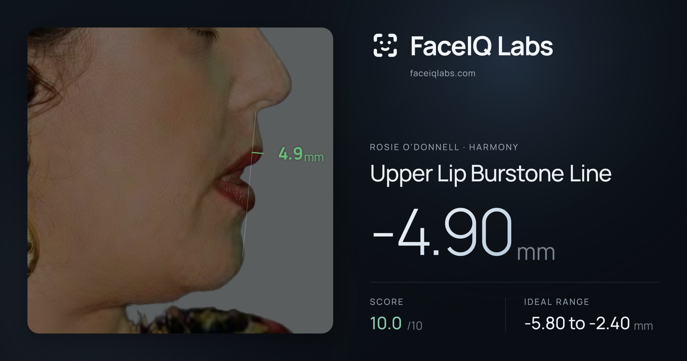 Rosie O'Donnell Upper Lip Burstone Line: -4.90mm, drawn on the photo