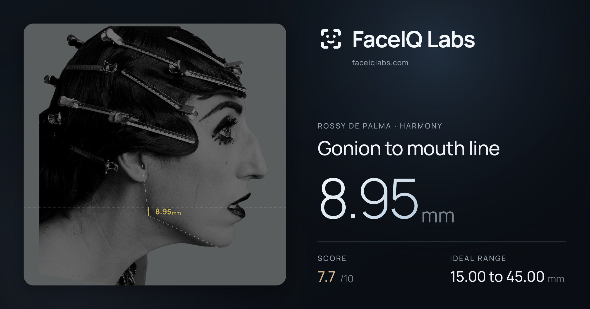 Rossy De Palma Gonion to mouth line: 8.95mm, drawn on the photo