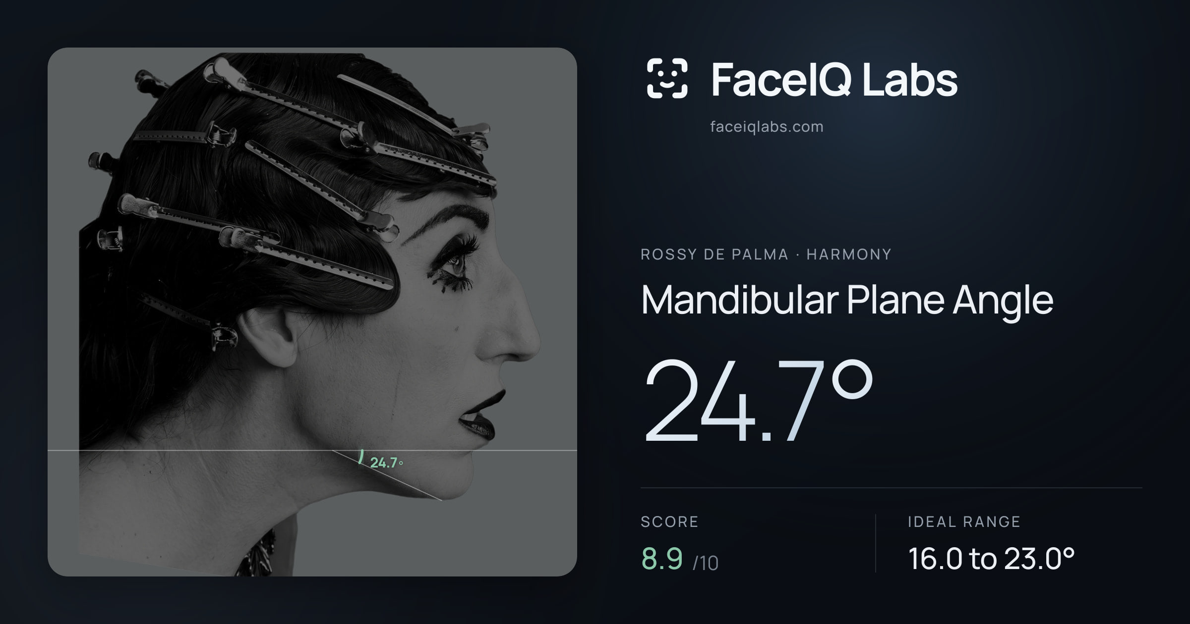 Rossy De Palma Mandibular Plane Angle: 24.7°, drawn on the photo