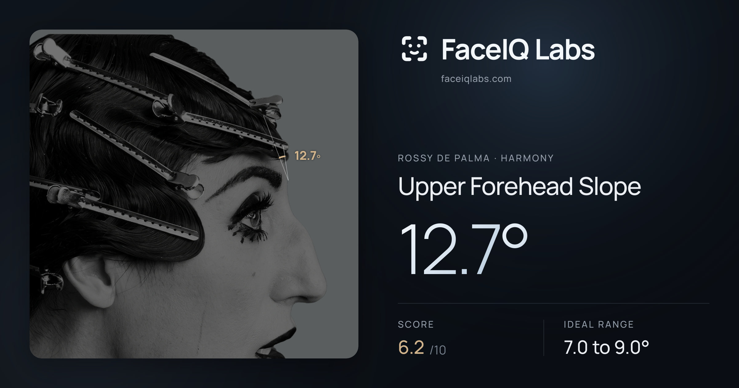 Rossy De Palma Upper Forehead Slope: 12.7°, drawn on the photo