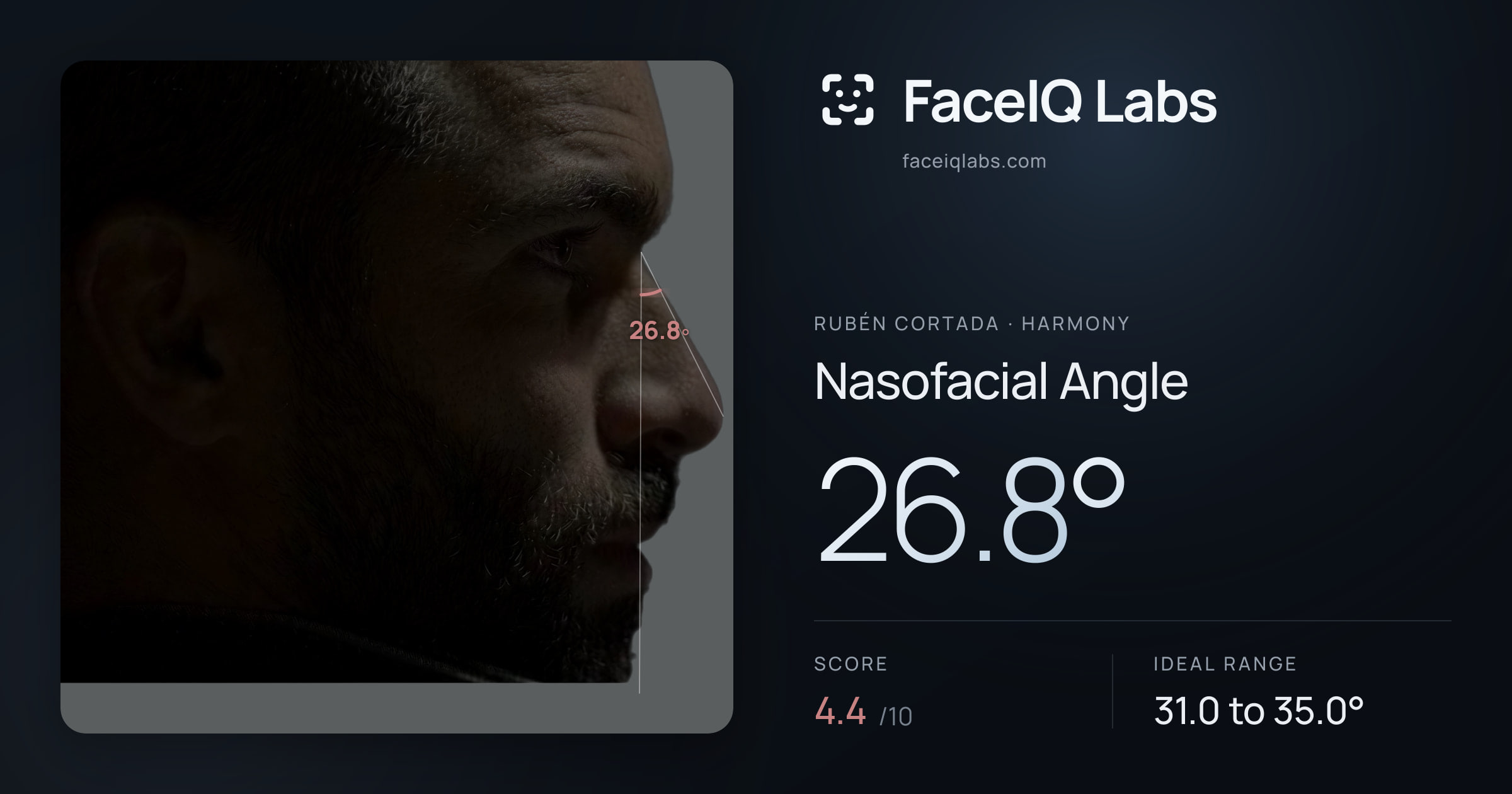 Rubén Cortada Nasofacial Angle: 26.8°, drawn on the photo