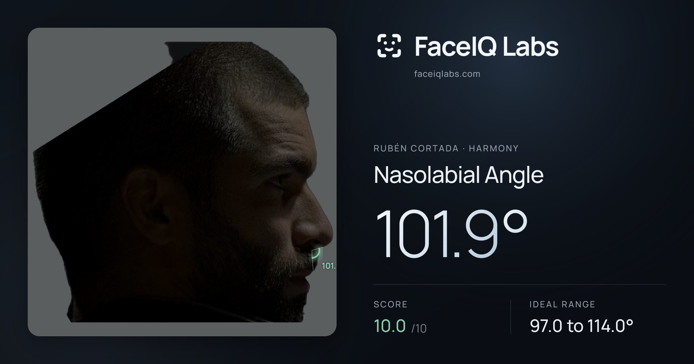 Rubén Cortada Nasolabial Angle: 101.9°, drawn on the photo