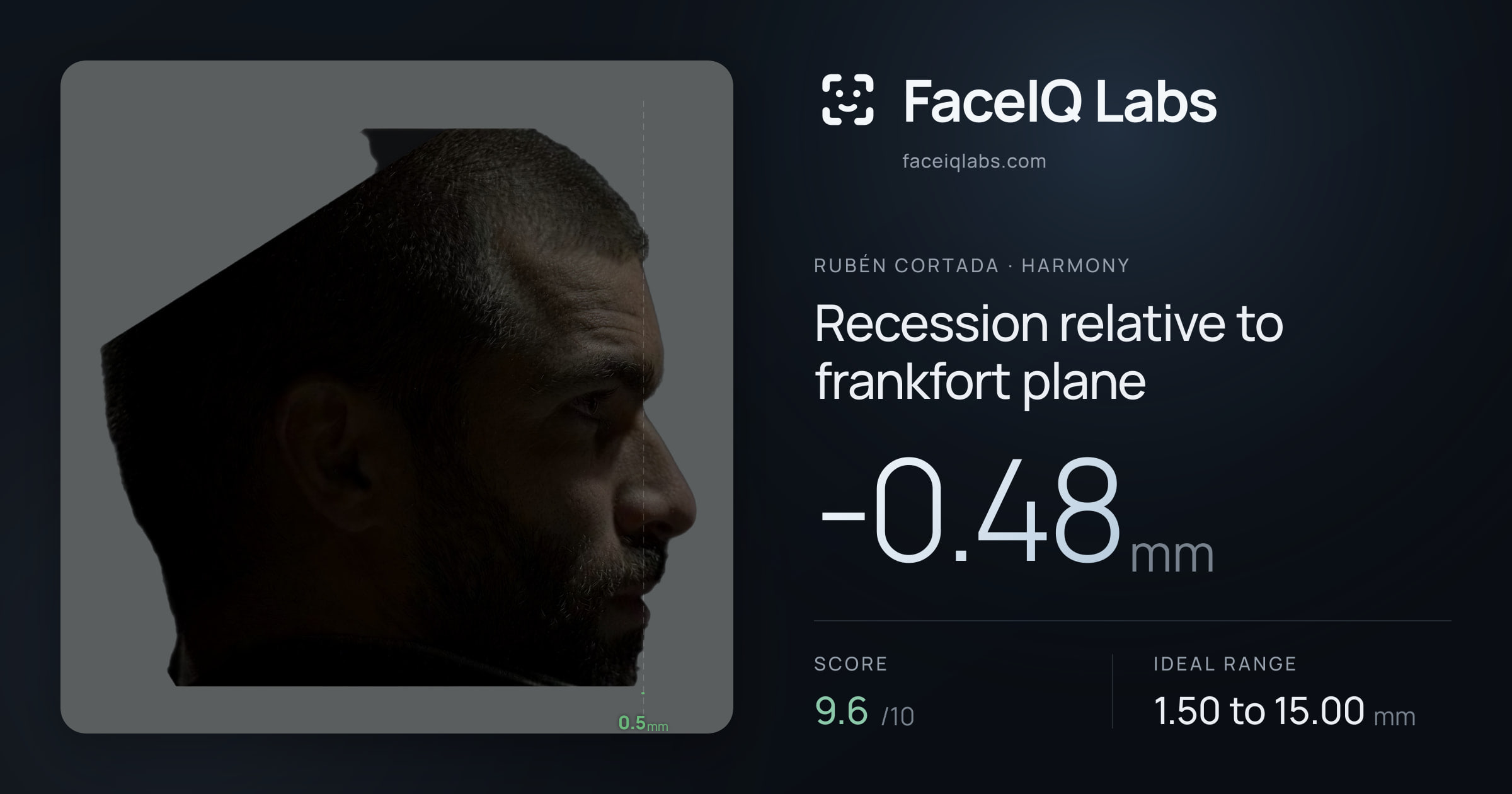 Rubén Cortada Recession relative to frankfort plane: -0.48mm, drawn on the photo