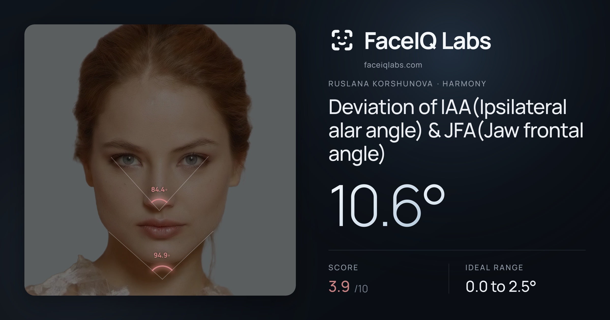 Ruslana Korshunova Deviation of IAA(Ipsilateral alar angle) & JFA(Jaw frontal angle): 10.6°, drawn on the photo