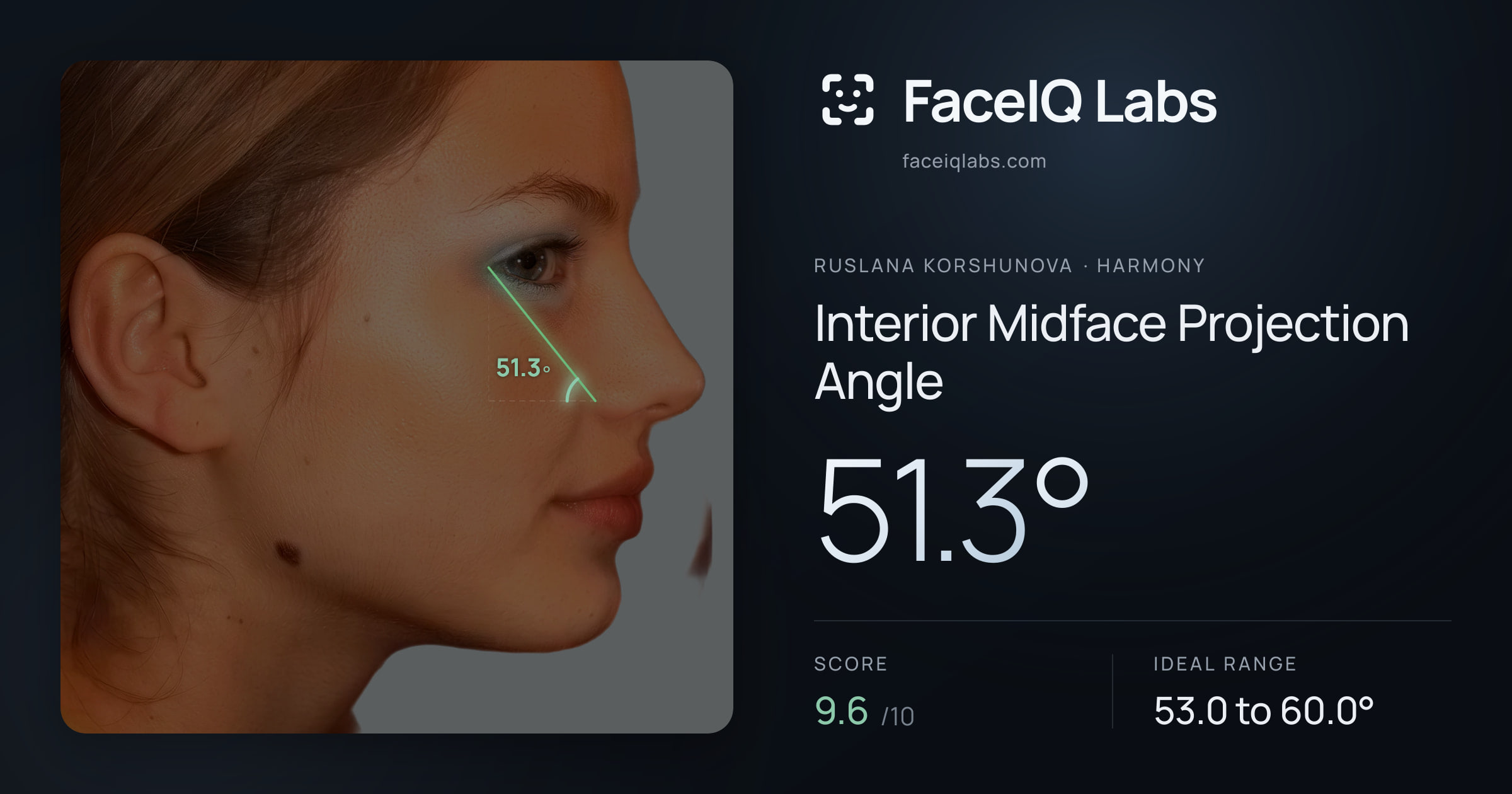Ruslana Korshunova Interior Midface Projection Angle: 51.3°, drawn on the photo