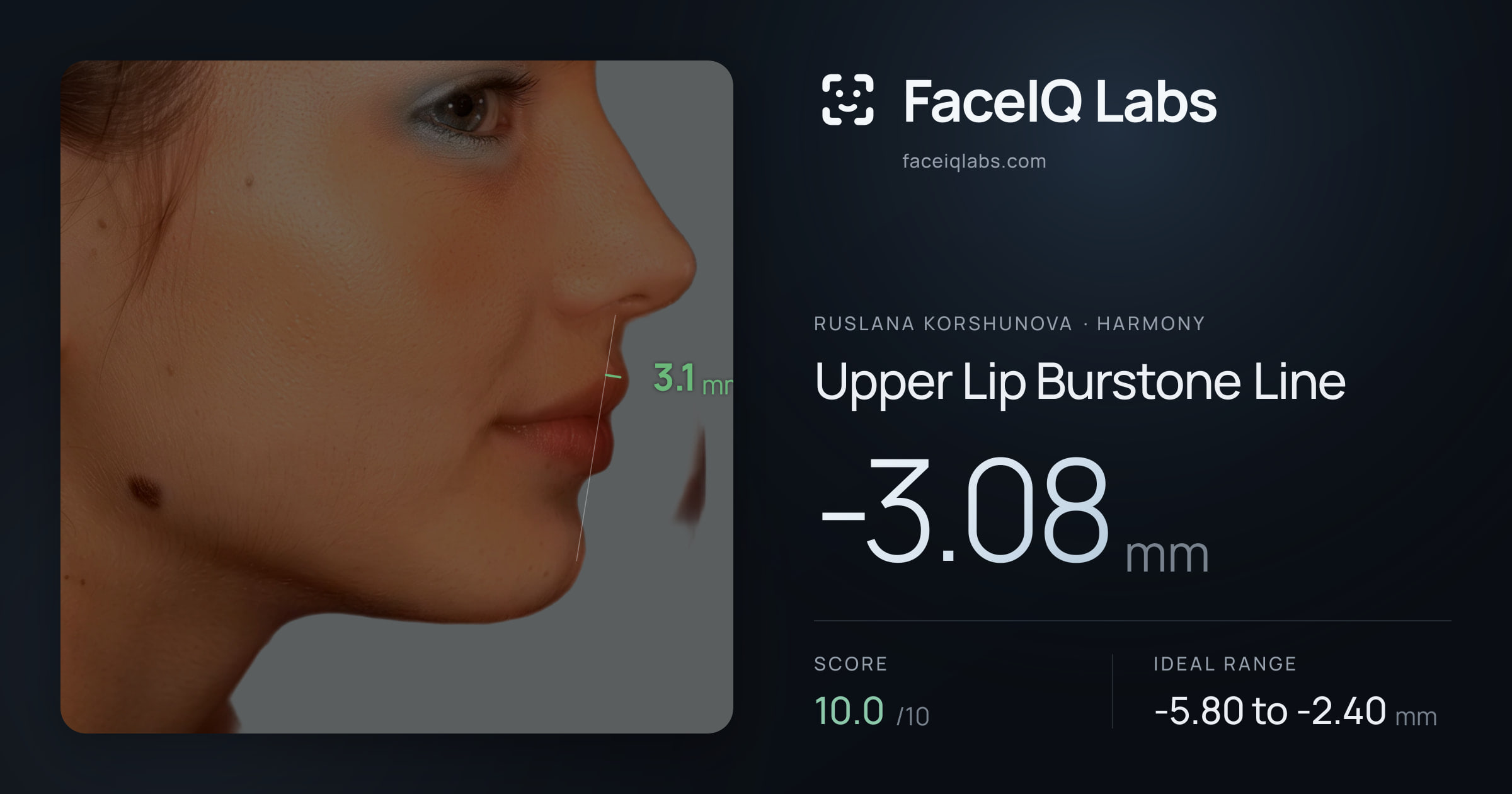 Ruslana Korshunova Upper Lip Burstone Line: -3.08mm, drawn on the photo