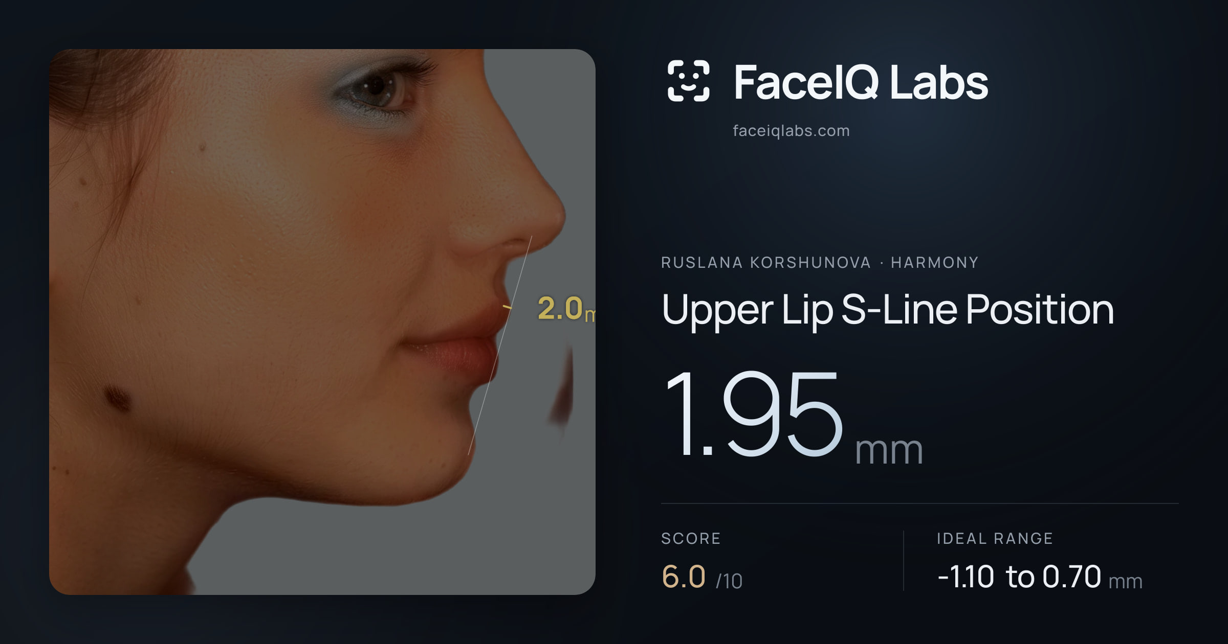 Ruslana Korshunova Upper Lip S-Line Position: 1.95mm, drawn on the photo
