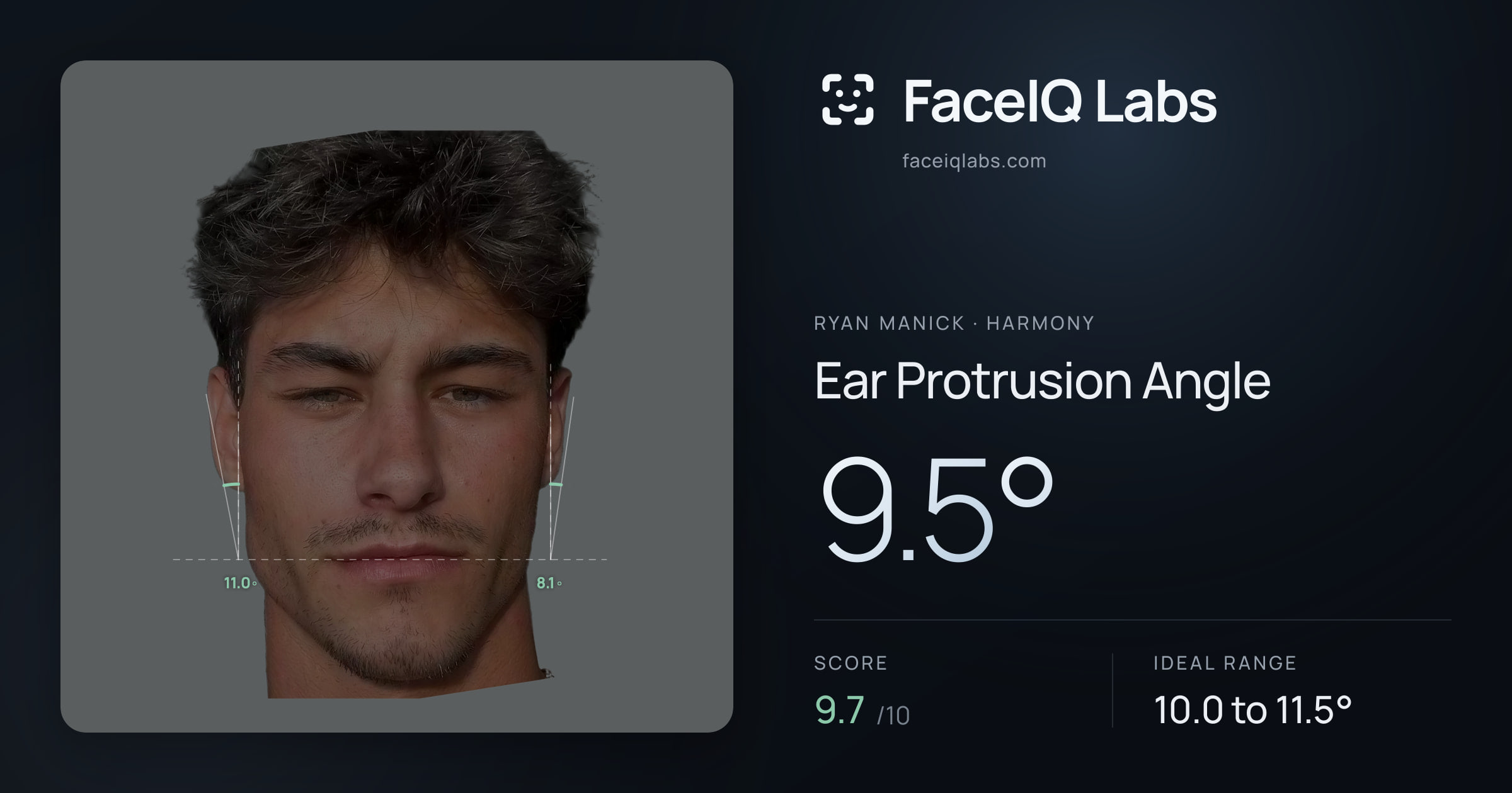 Ryan Manick Ear Protrusion Angle: 9.5°, drawn on the photo