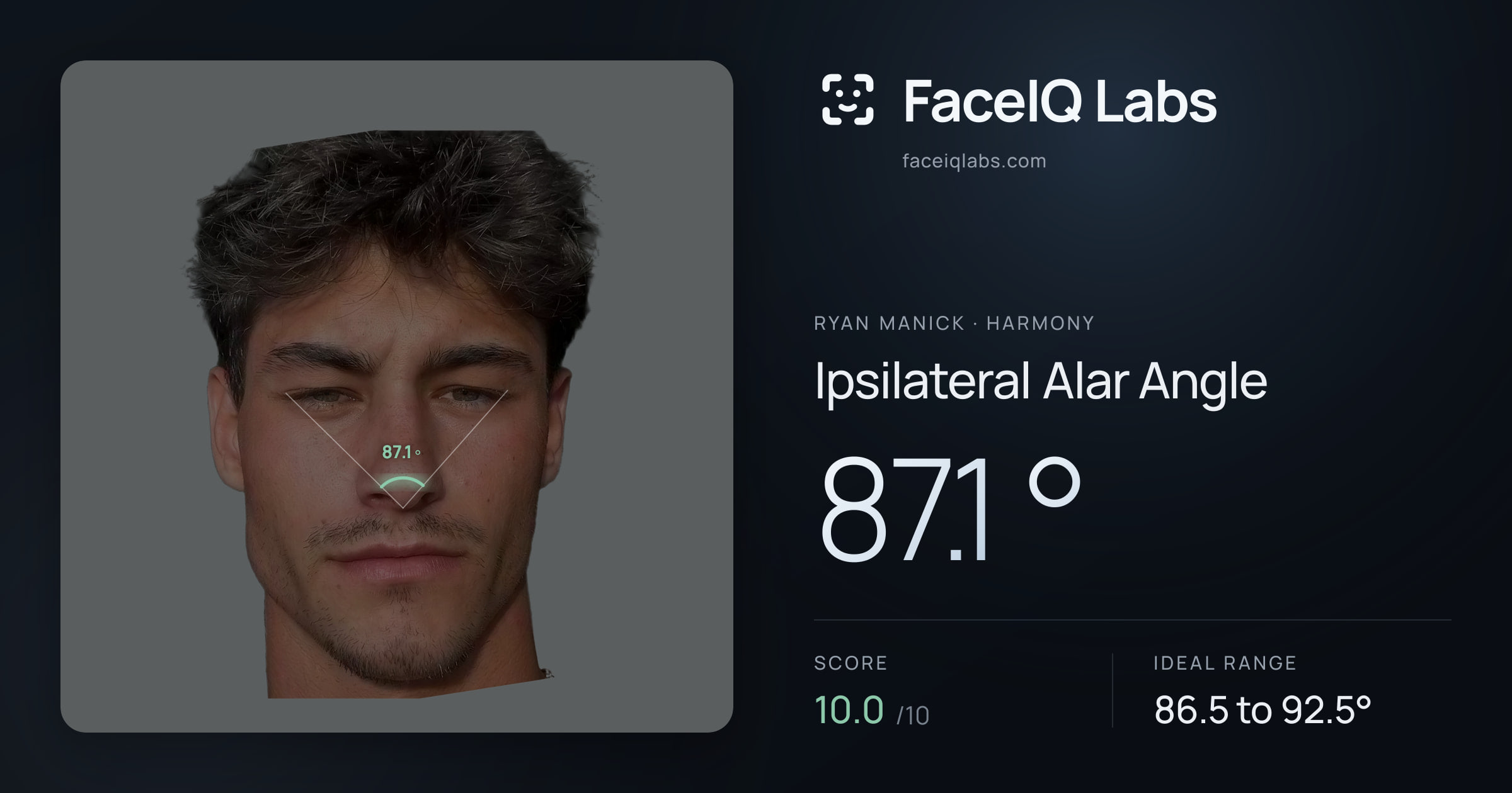 Ryan Manick Ipsilateral Alar Angle: 87.1°, drawn on the photo