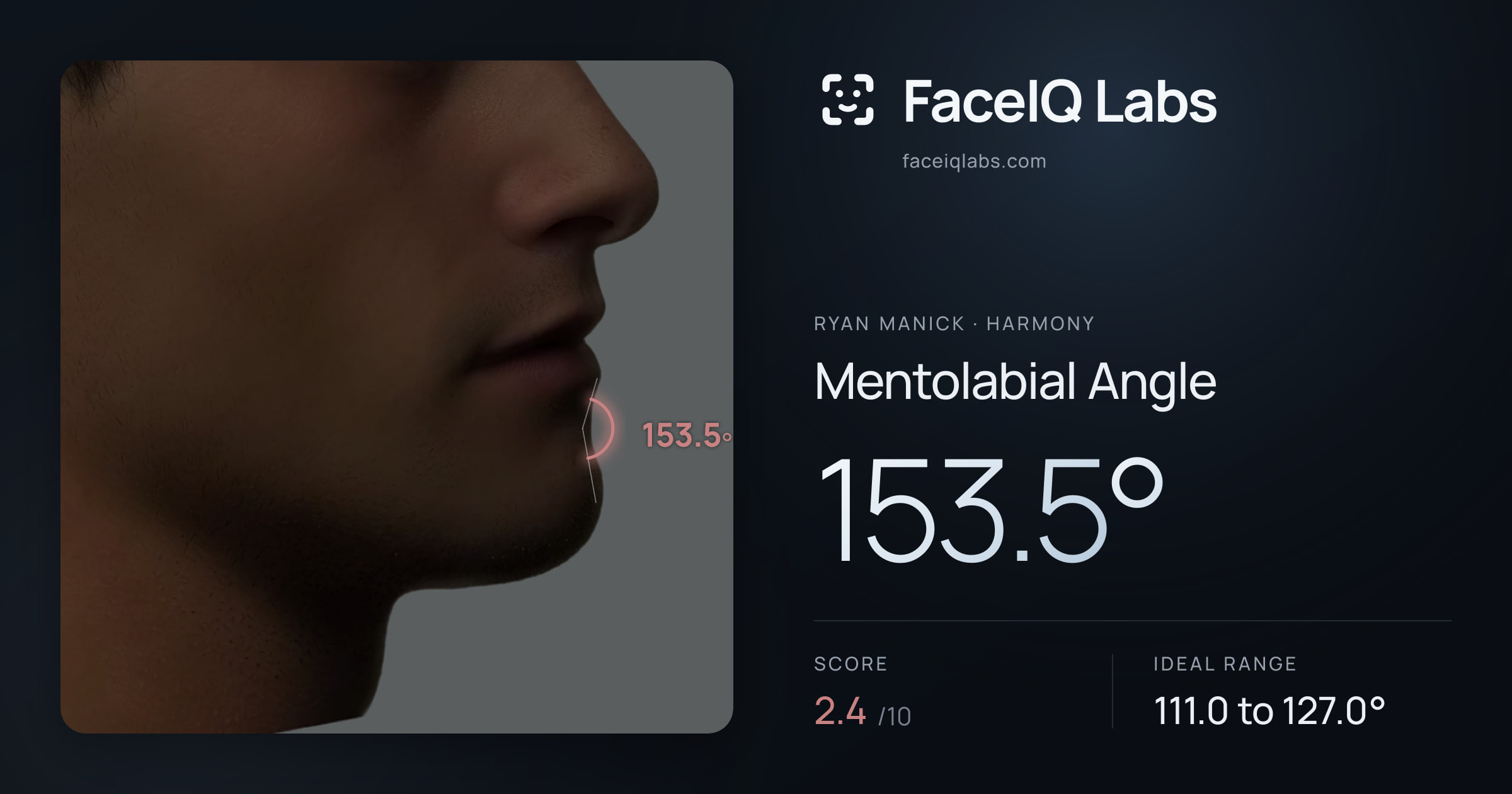 Ryan Manick Mentolabial Angle: 153.5°, drawn on the photo