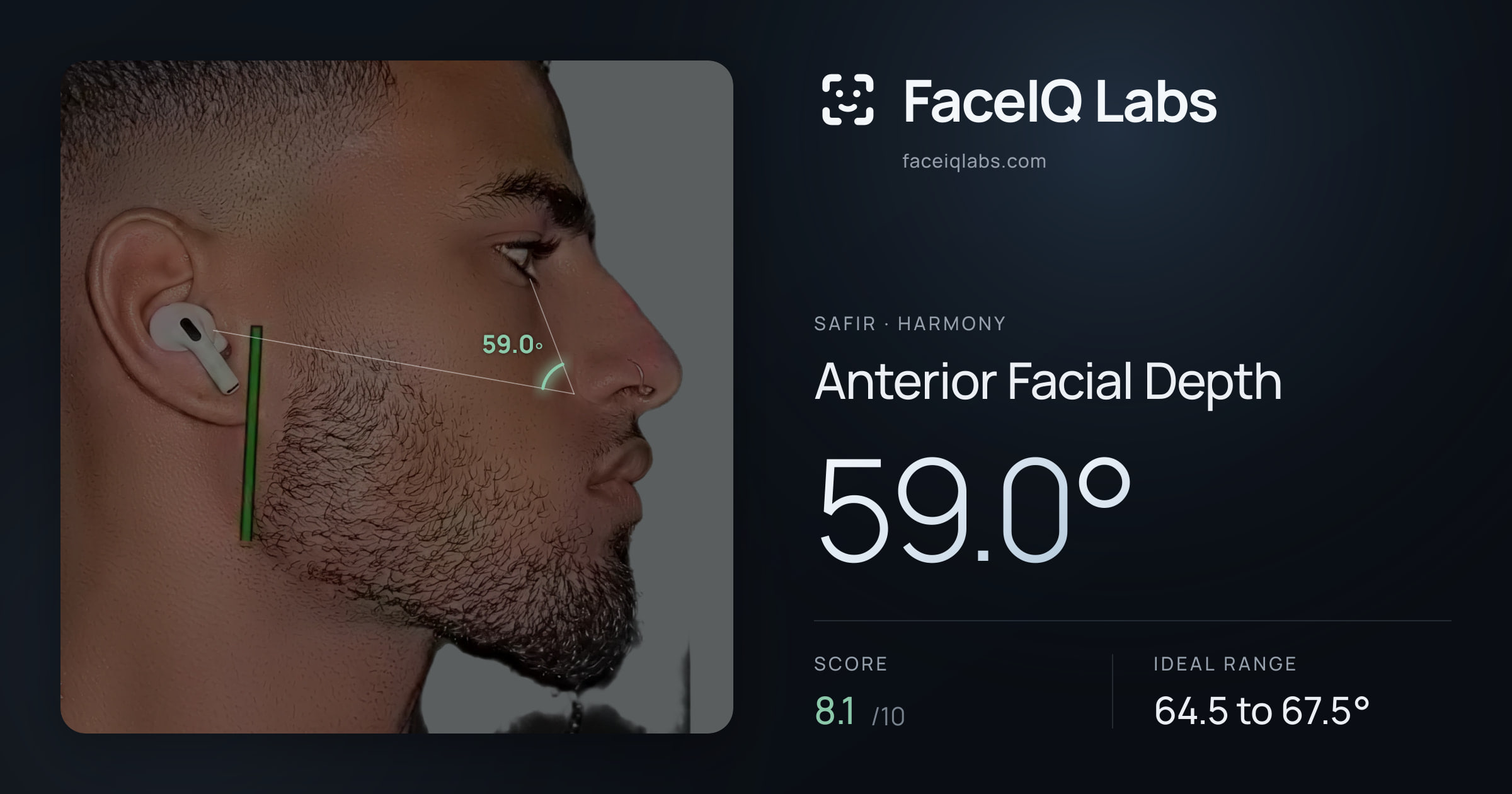 Safir Anterior Facial Depth: 59.0°, drawn on the photo