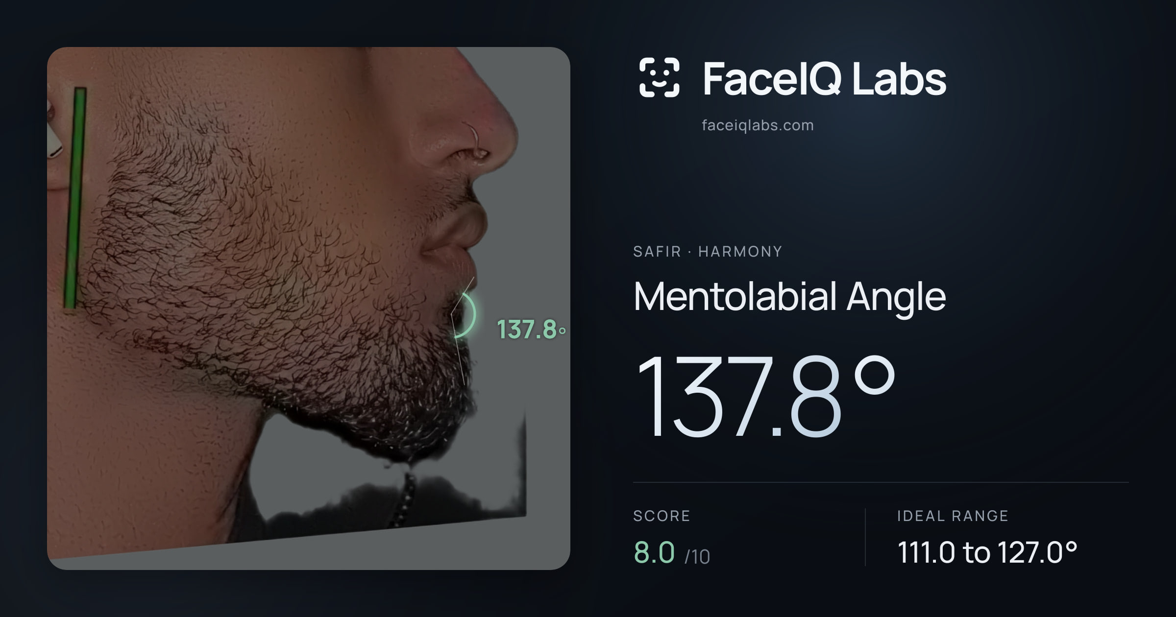 Safir Mentolabial Angle: 137.8°, drawn on the photo