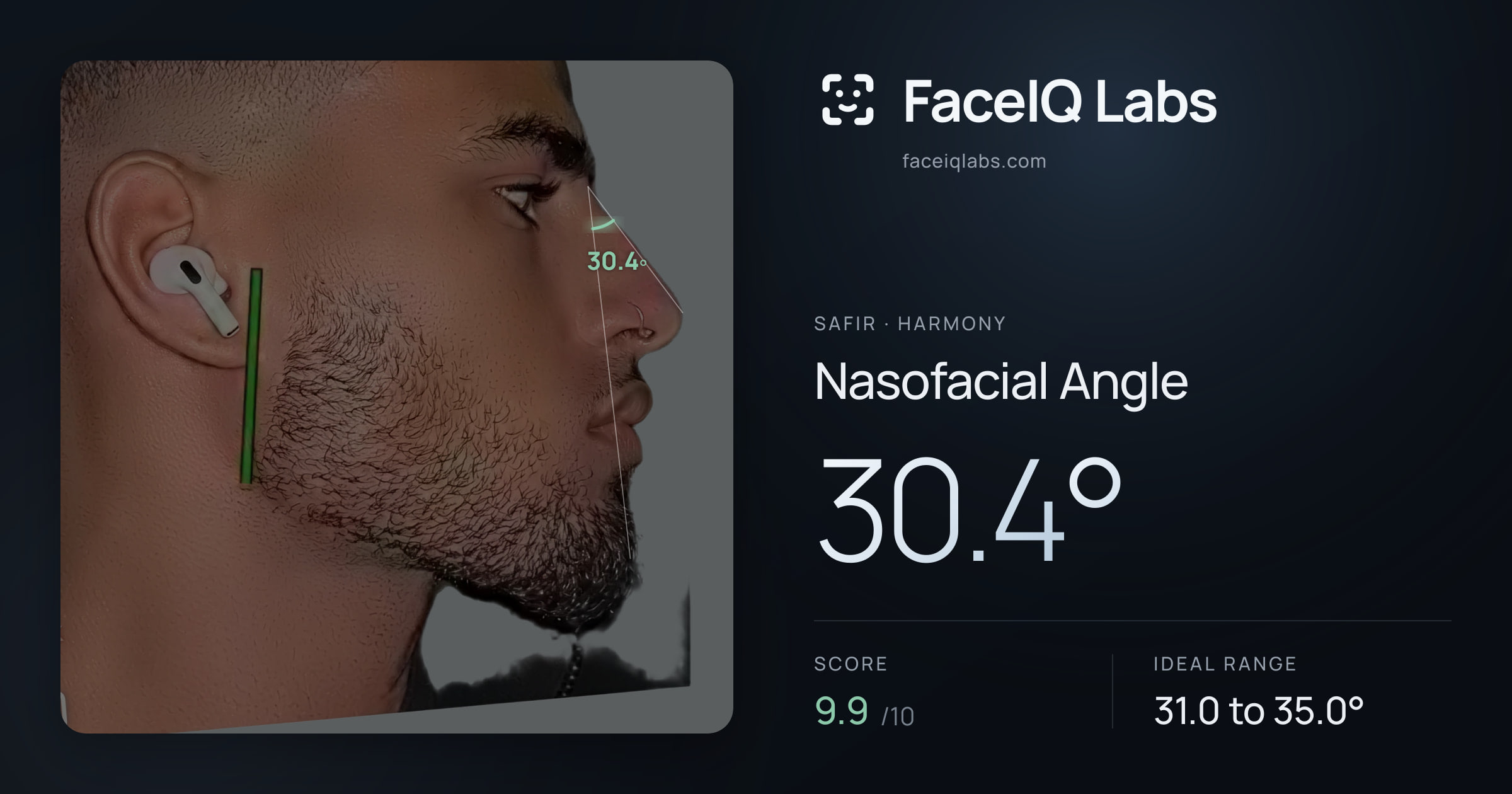 Safir Nasofacial Angle: 30.4°, drawn on the photo