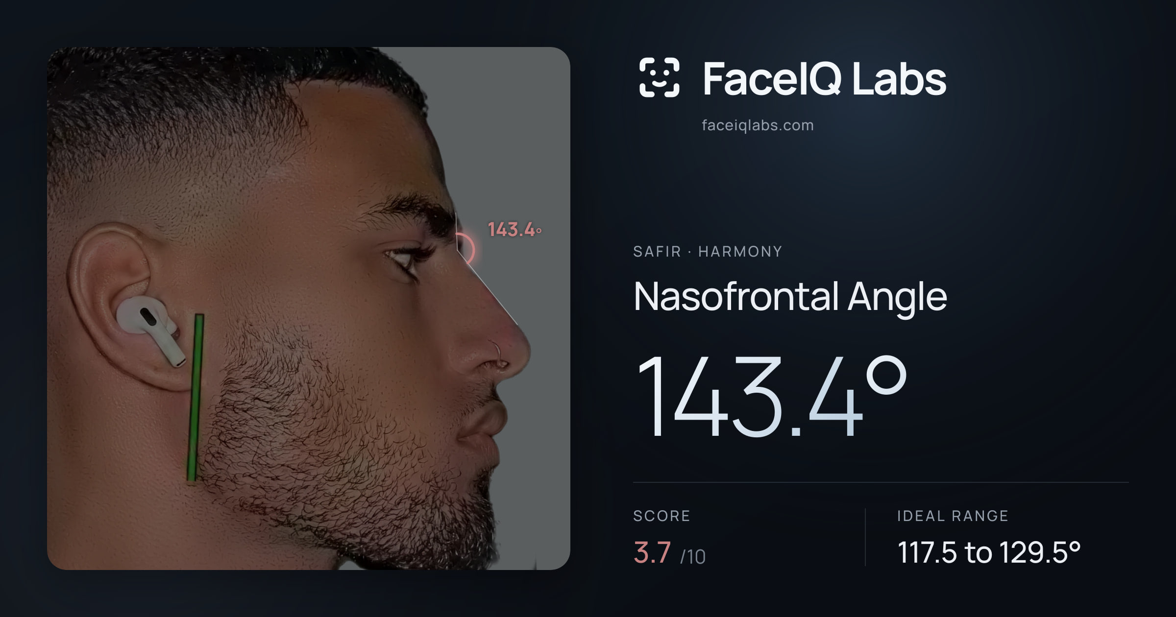 Safir Nasofrontal Angle: 142.5°, drawn on the photo