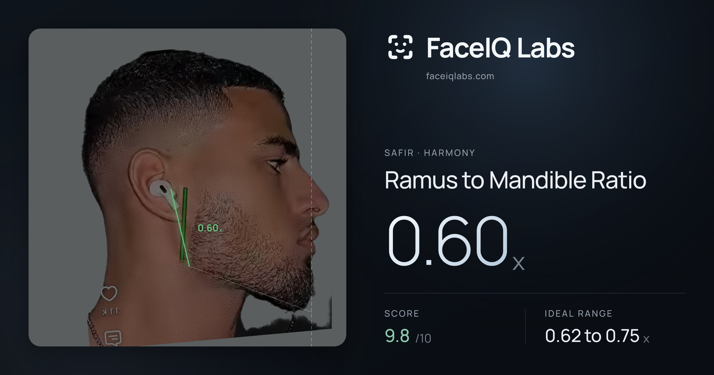 Safir Ramus to Mandible Ratio: 0.61x, drawn on the photo