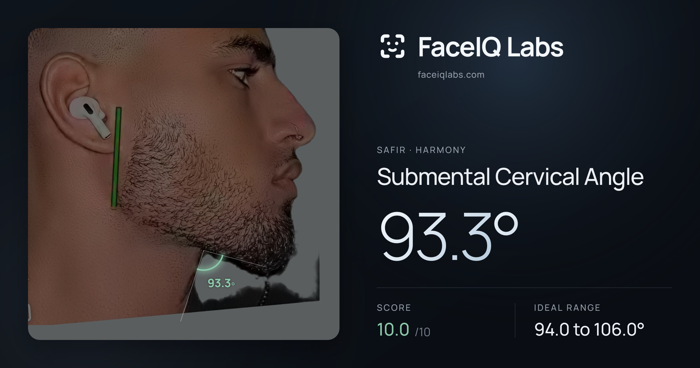 Safir Submental Cervical Angle: 93.3°, drawn on the photo